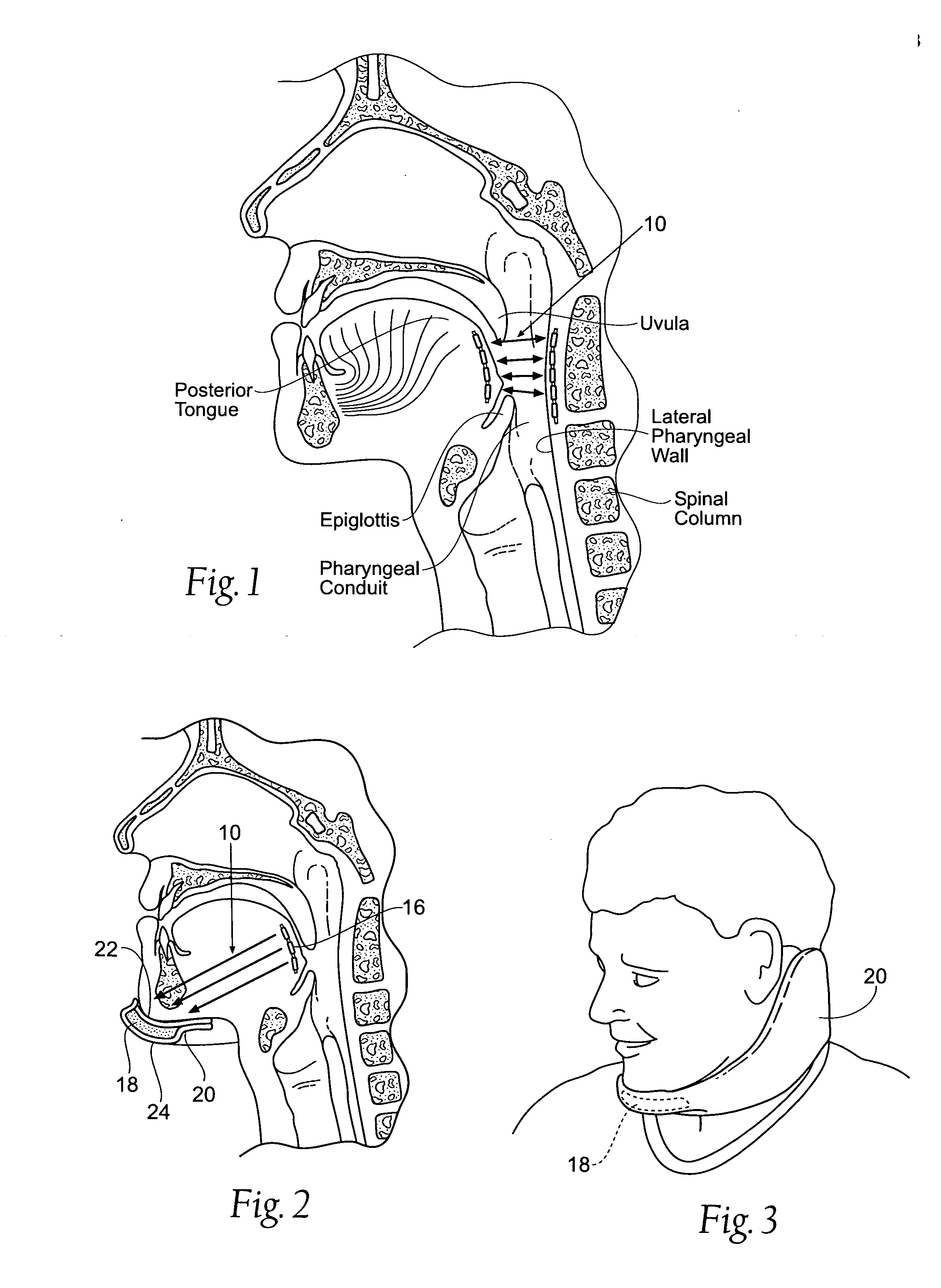 Devices, systems, and methods for stabilization or fixation of magnetic force devices used in or on a body