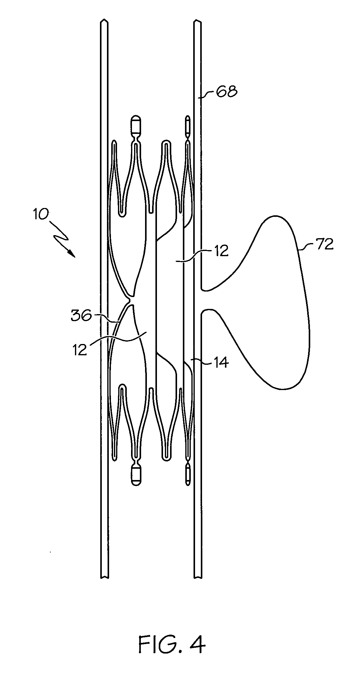 Flap-cover aneurysm stent