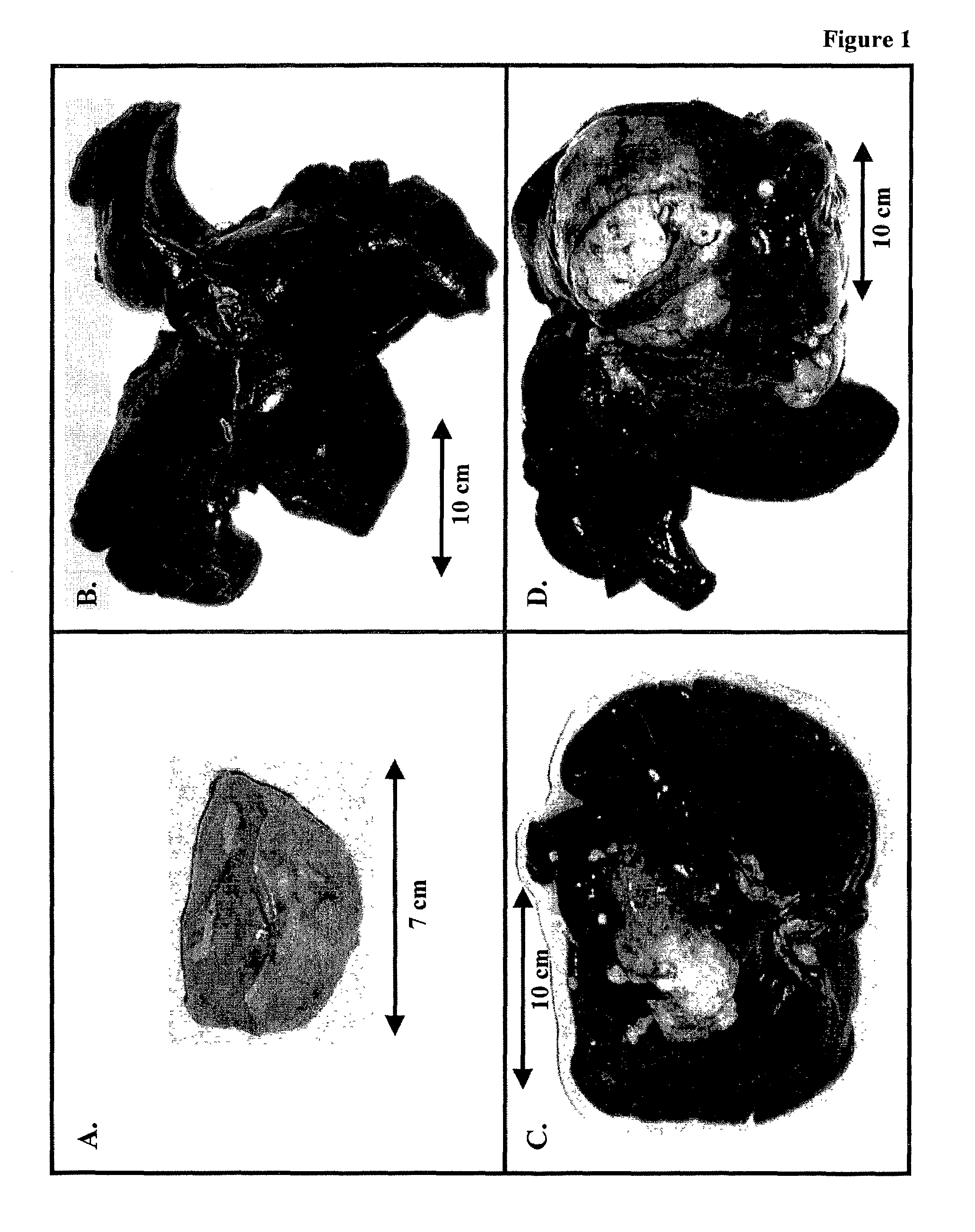 Therapeutics for cancer using 3-bromopyruvate and other selective inhibitors of ATP production