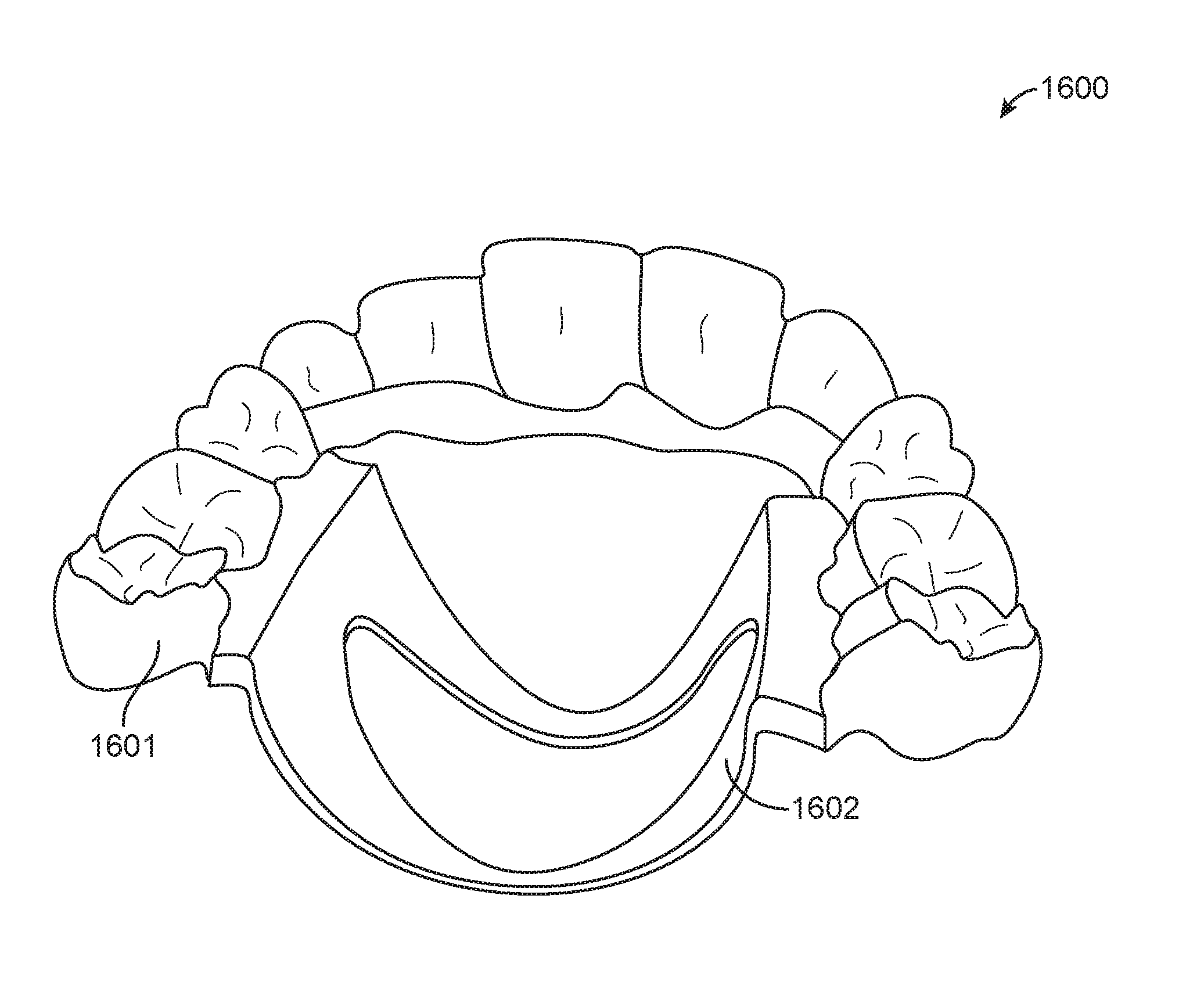 Direct fabrication of aligners for arch expansion