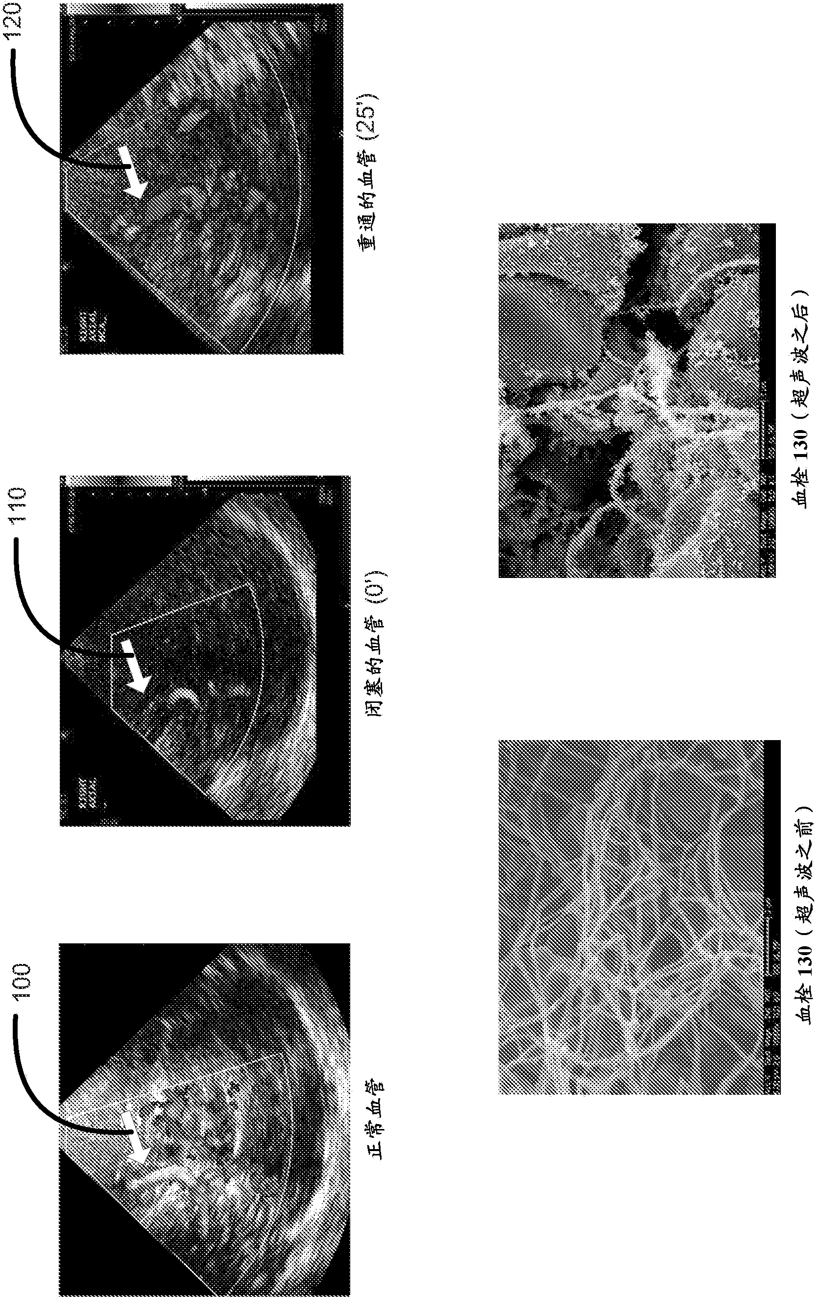 Portable device to initiate and monitor treatment of stroke victims in the field