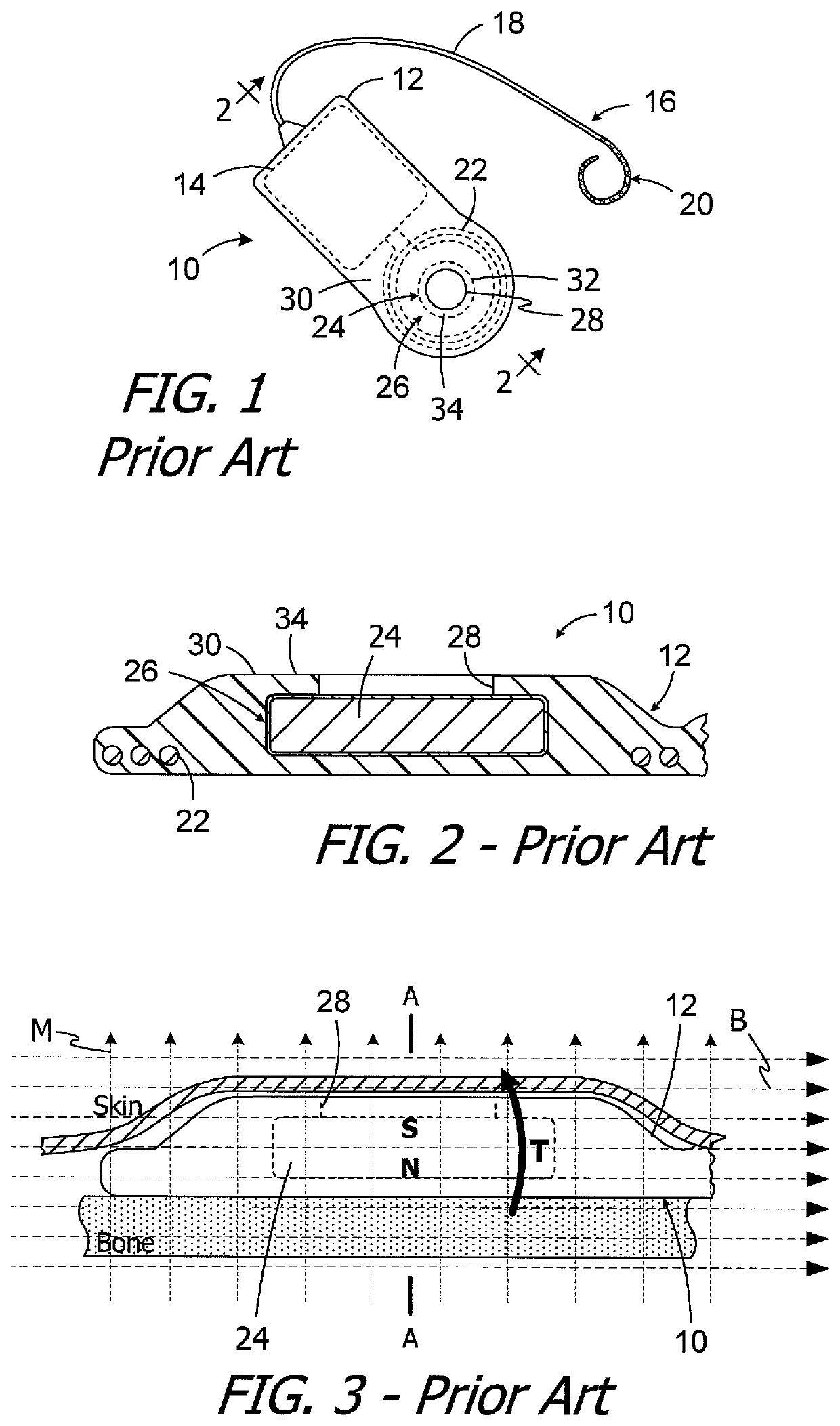 Cochlear implants, magnets for use with same and magnet retrofit methods