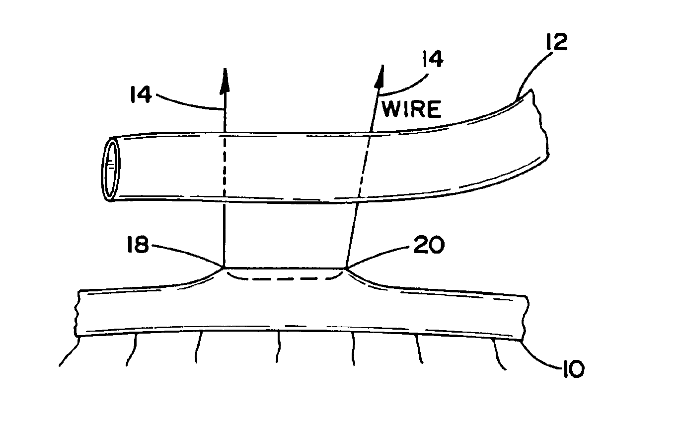 Arrangement and method for vascular anastomosis