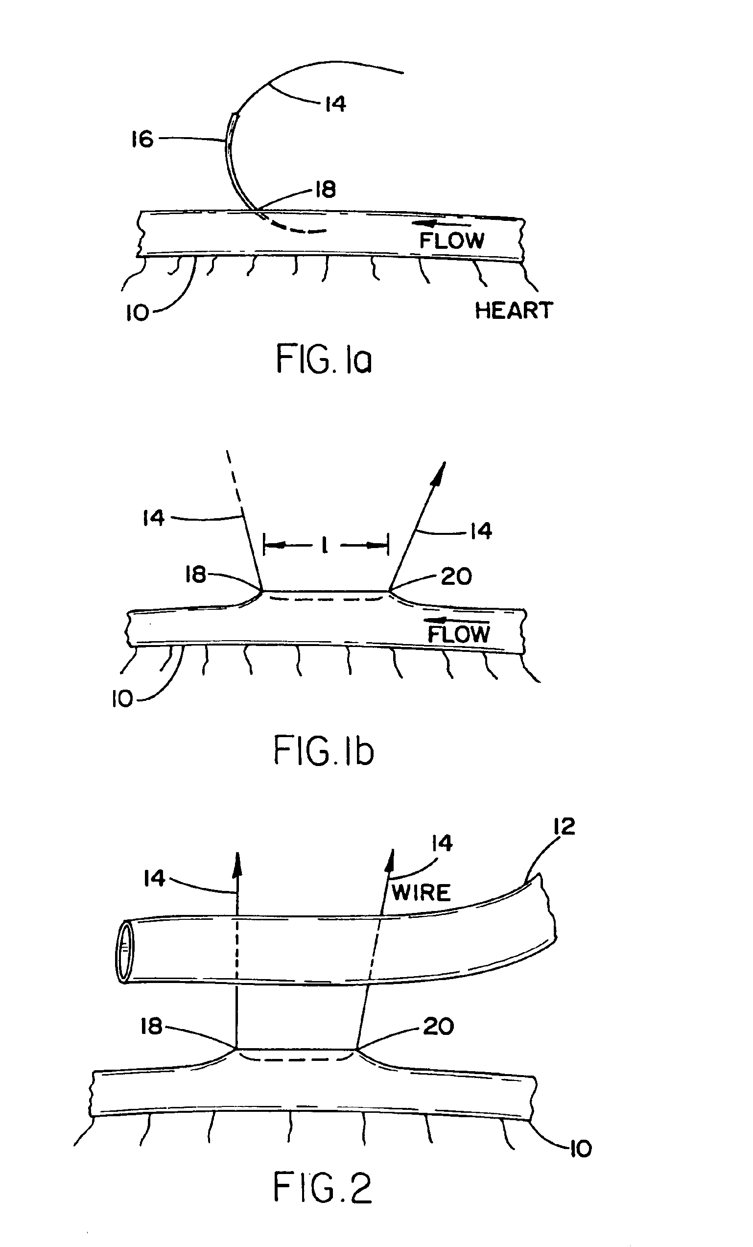 Arrangement and method for vascular anastomosis