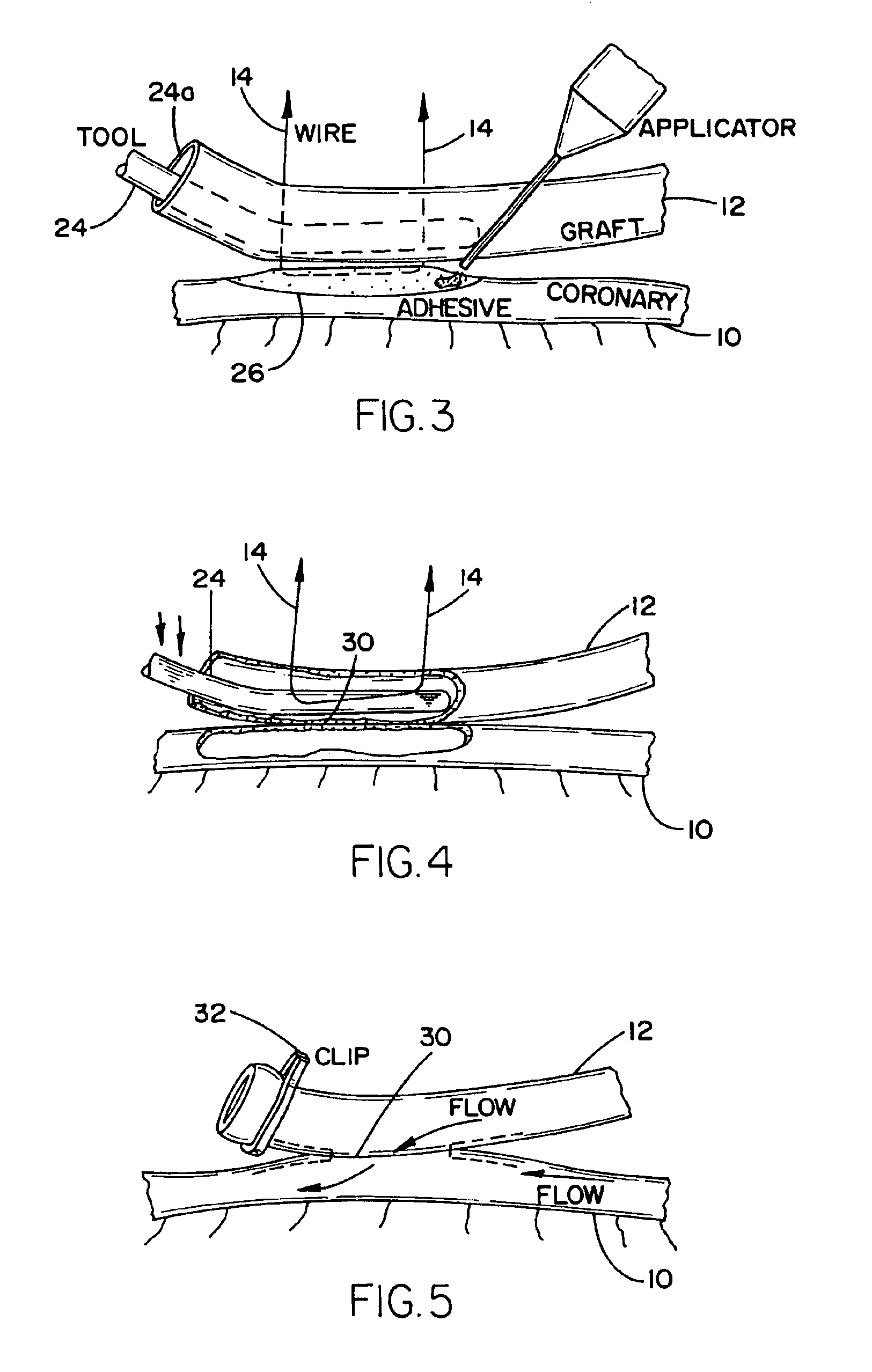 Arrangement and method for vascular anastomosis