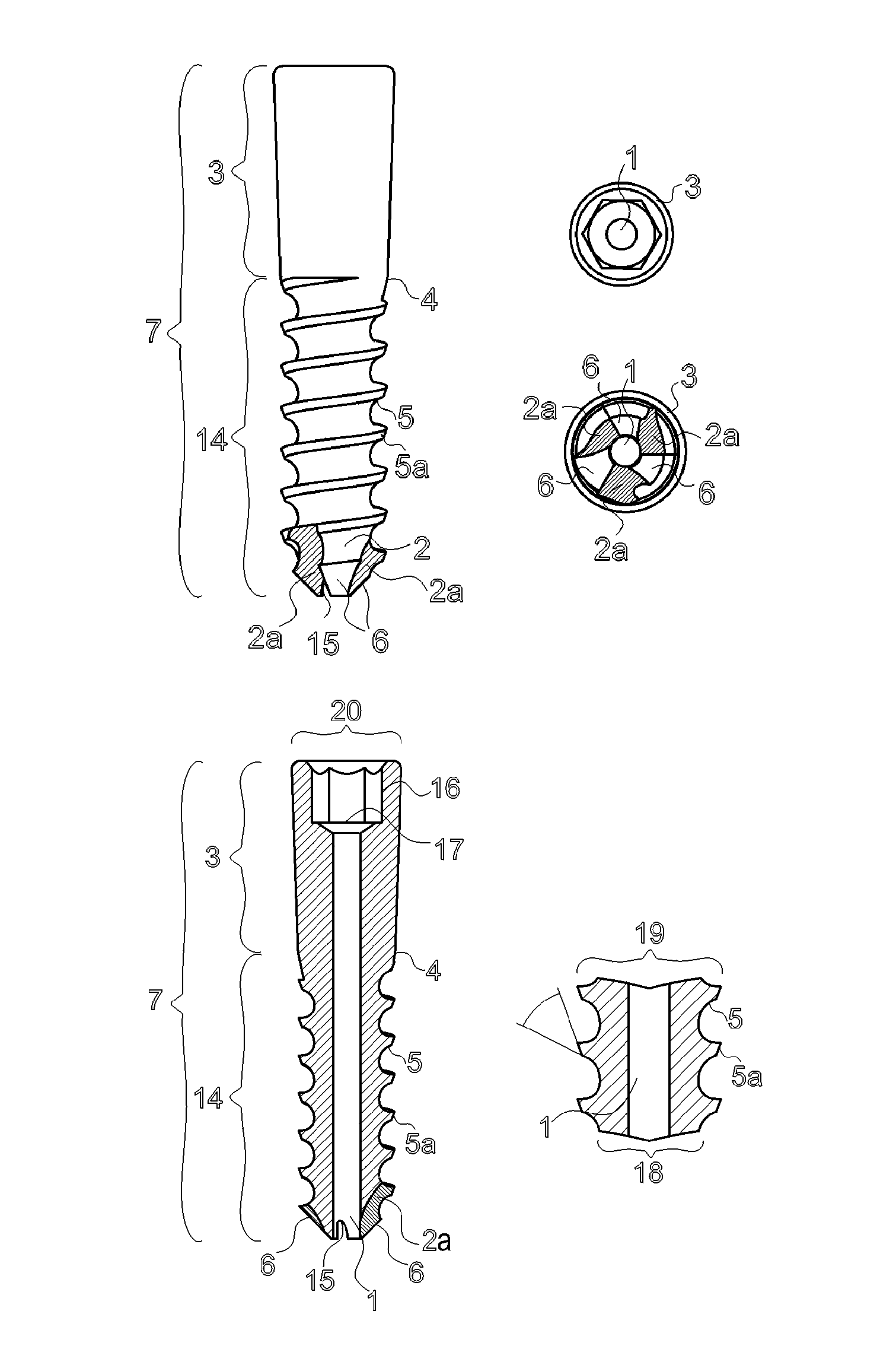 Canulated titanium implant for correcting flat feet in children