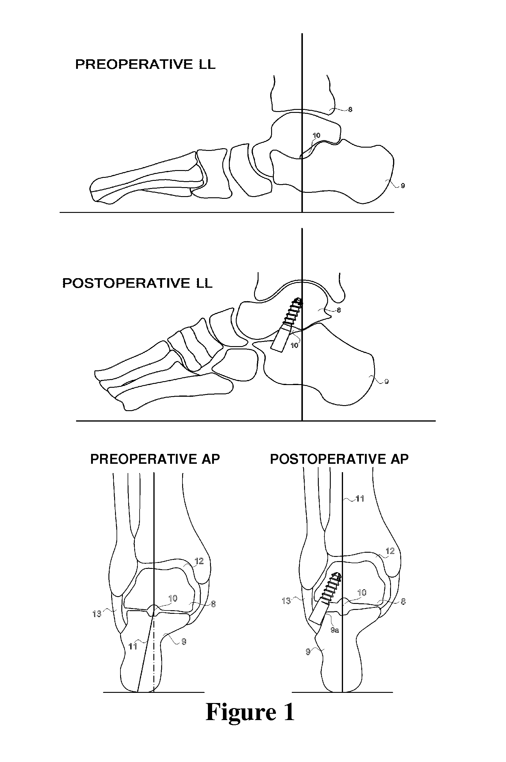 Canulated titanium implant for correcting flat feet in children