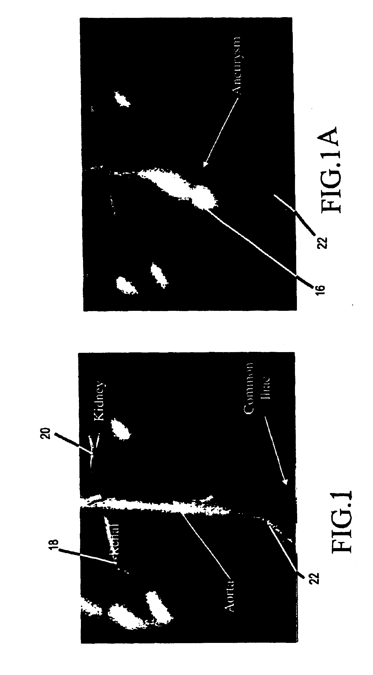 Three-dimensional system for abdominal aortic aneurysm evaluation