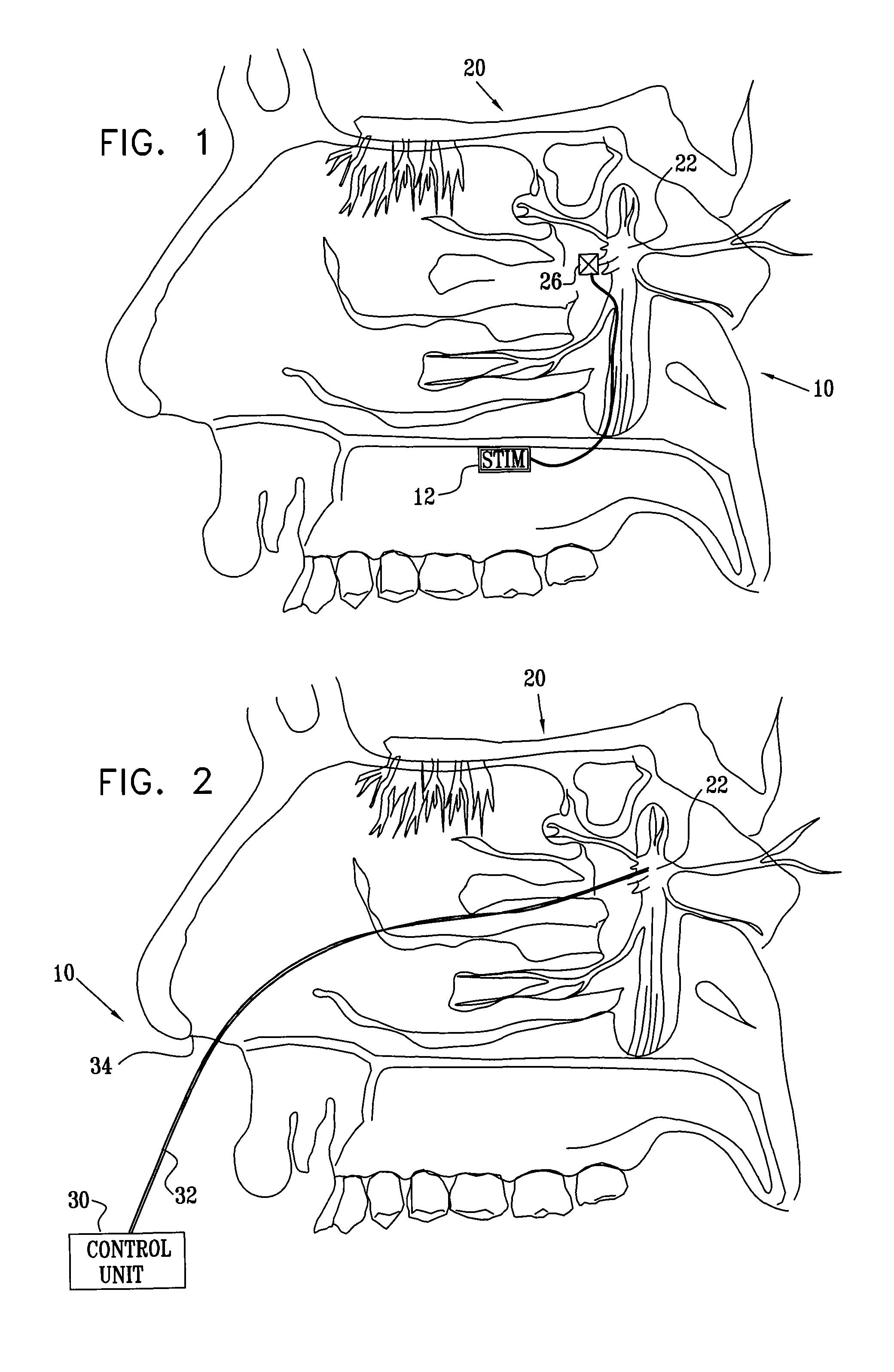 Stimulation for treating brain events and other conditions