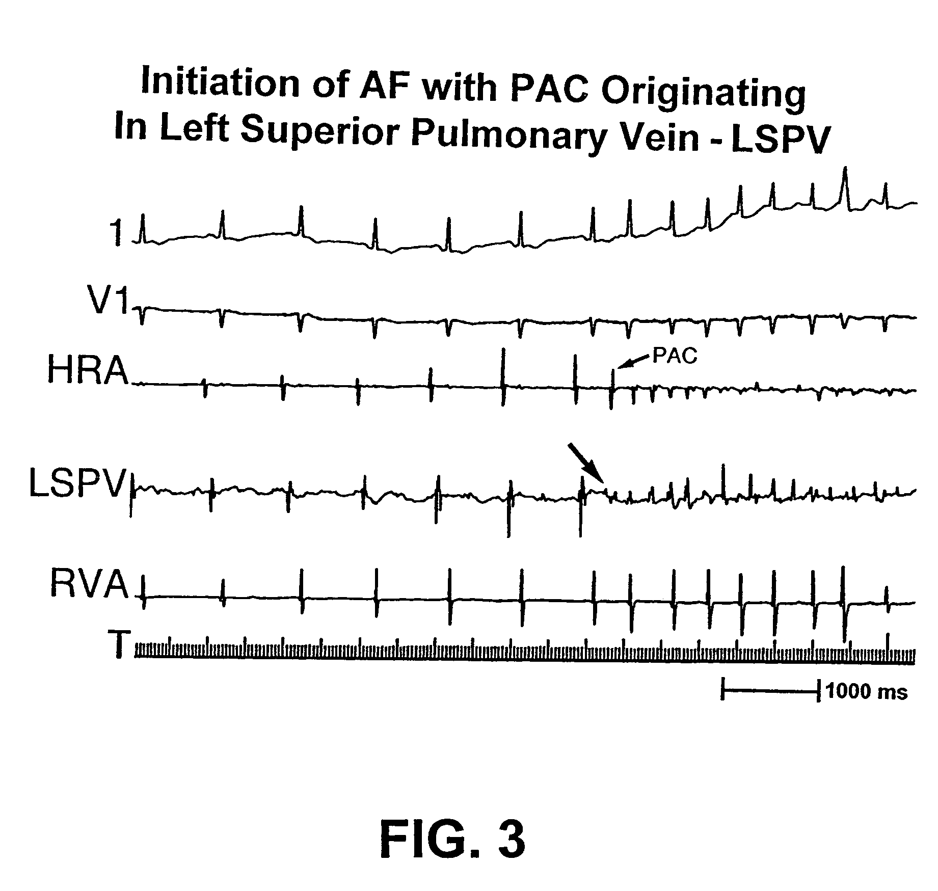 Catheter apparatus for treatment of heart arrhythmia