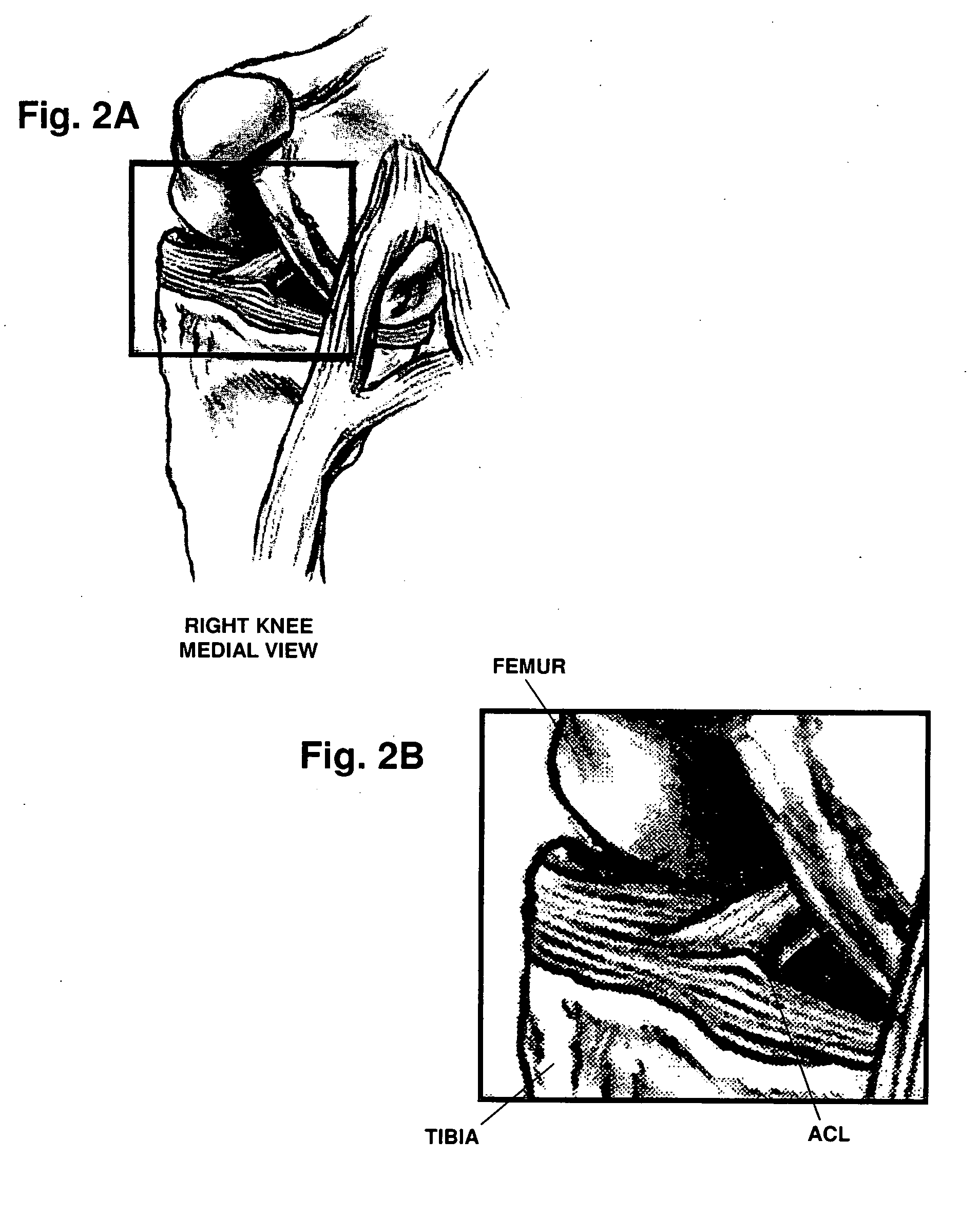 Method for repair and reconstruction of ruptured ligaments or tendons and for treatment of ligament and tendon injuries