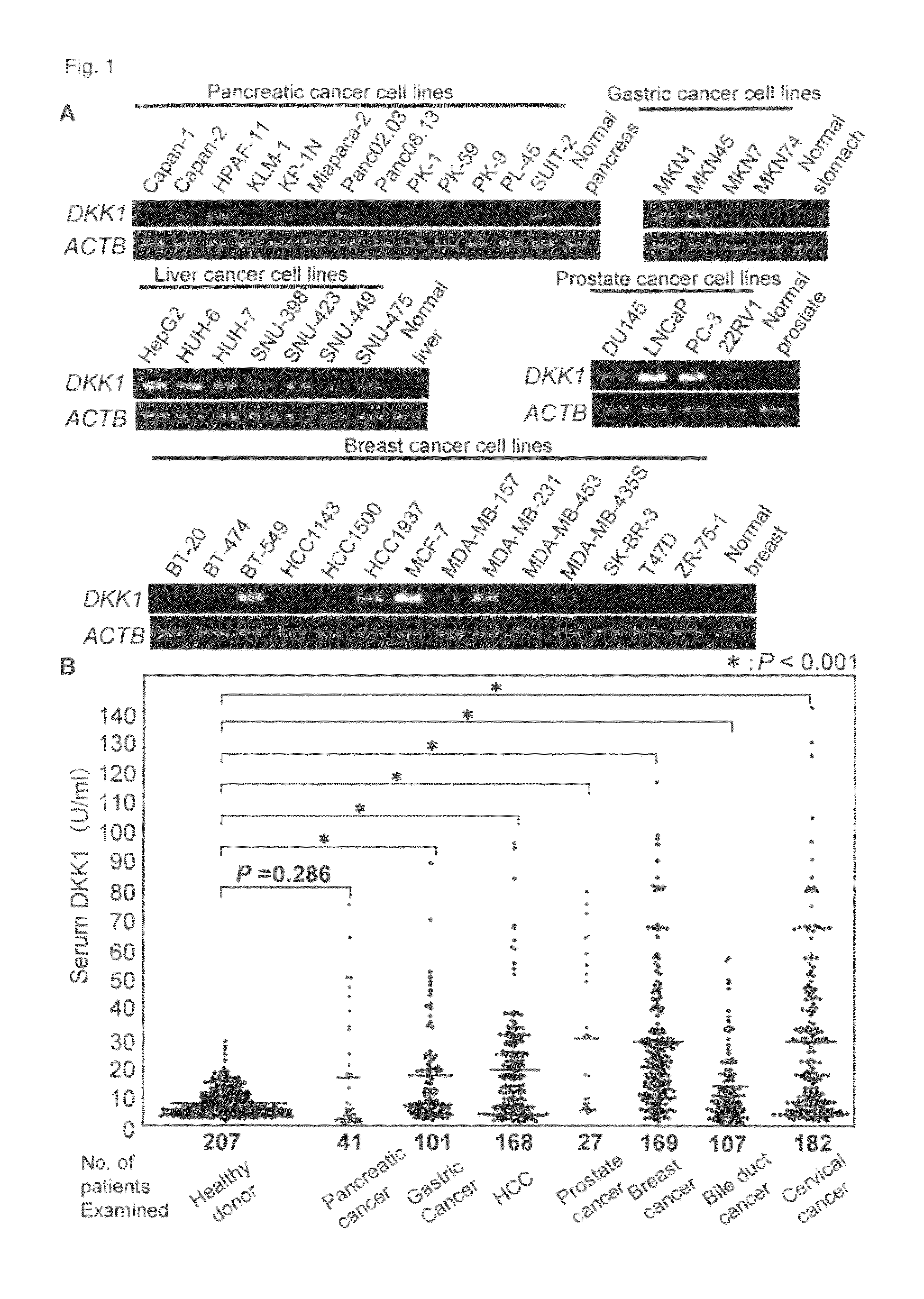 DKK1 oncogene as therapeutic target for cancer and a diagnosing marker