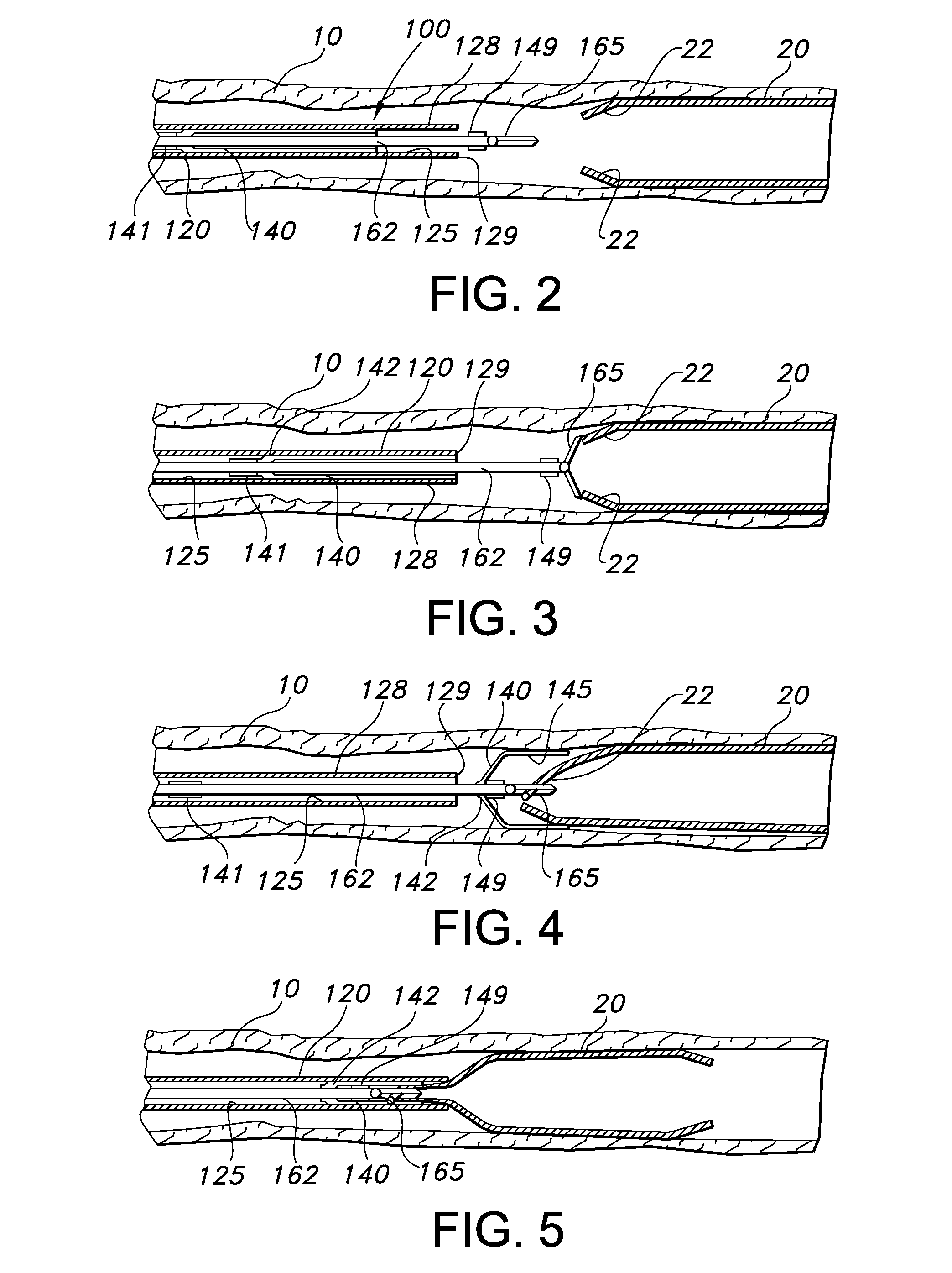 Intraluminary stent relocating apparatus