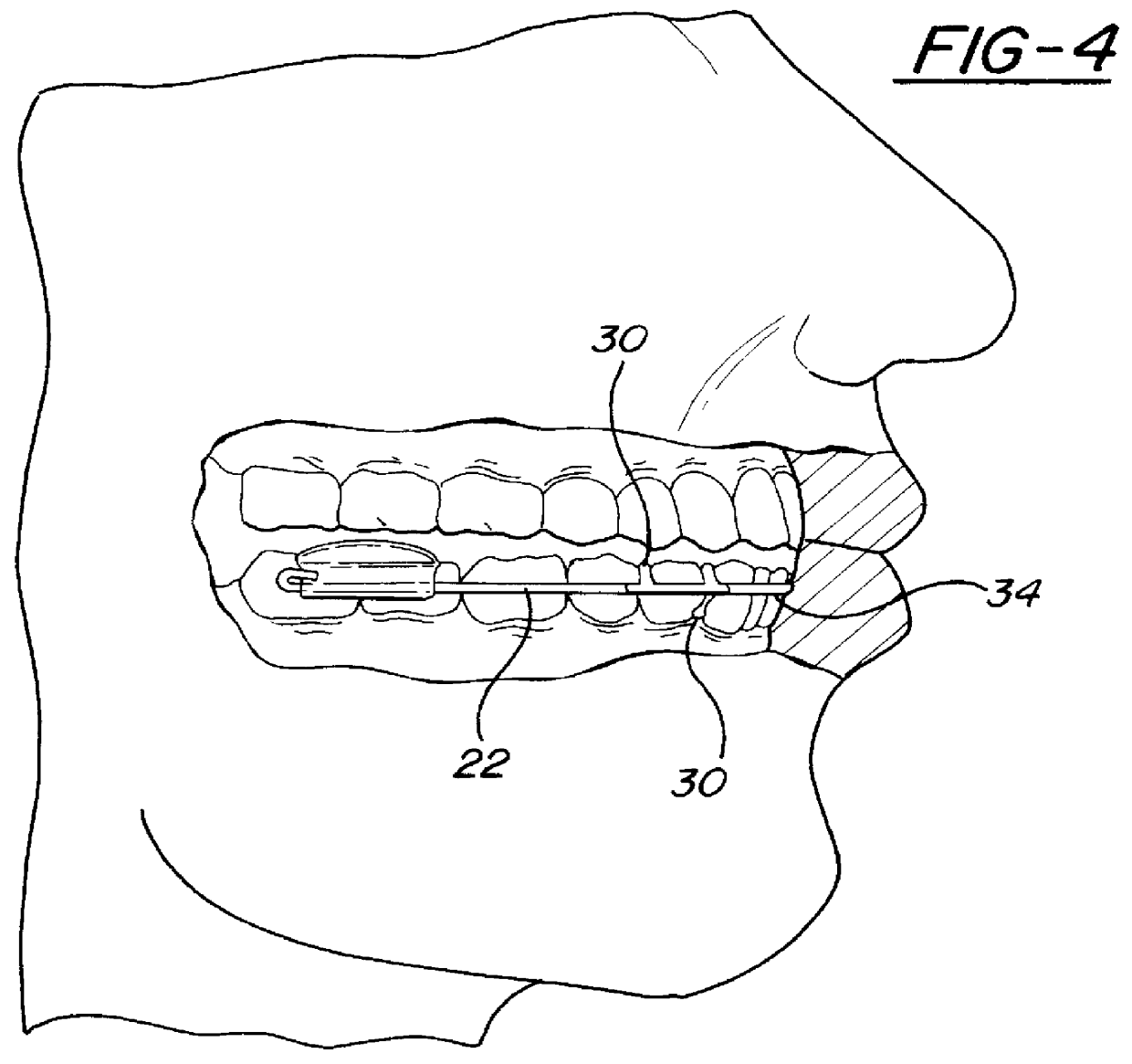 Taste-based approach to the prevention of teeth clenching and grinding