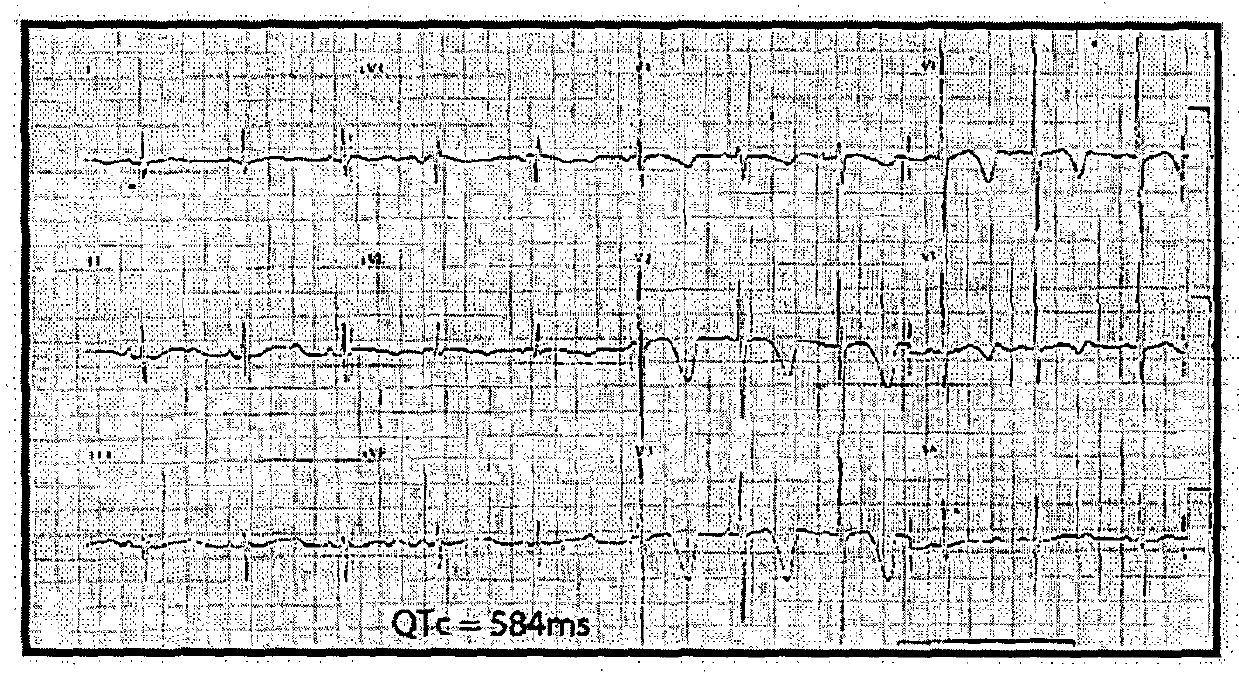 Re-trafficking of HERG reverses long QT syndrome 2 phenotype in human ips-derived cardiomyocytes