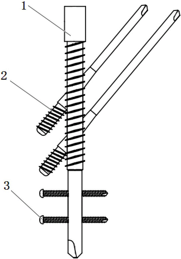 Improved intramedullary nail internal fixation device for femoral proximal fracture