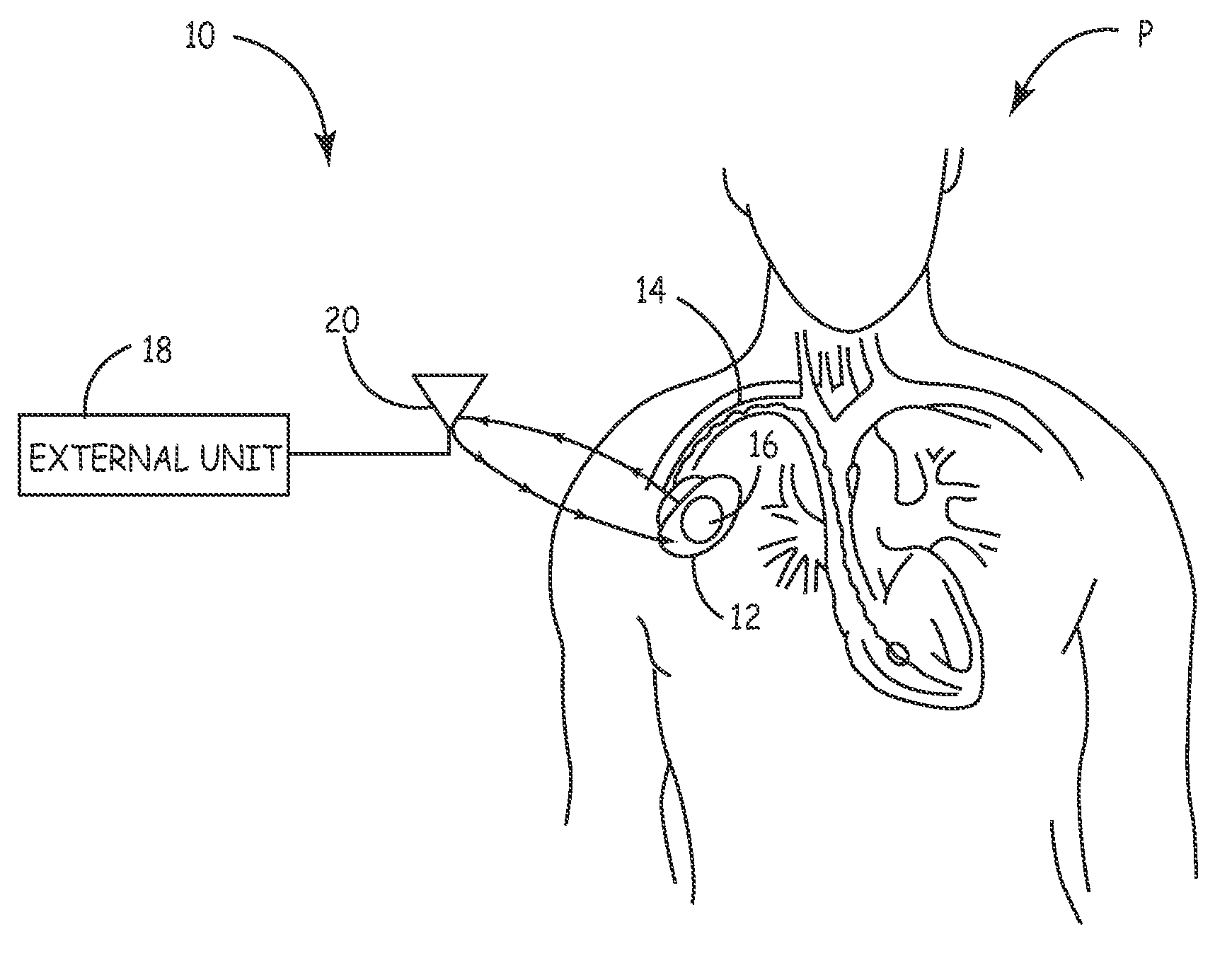 System and method for unscheduled wireless communication with a medical device