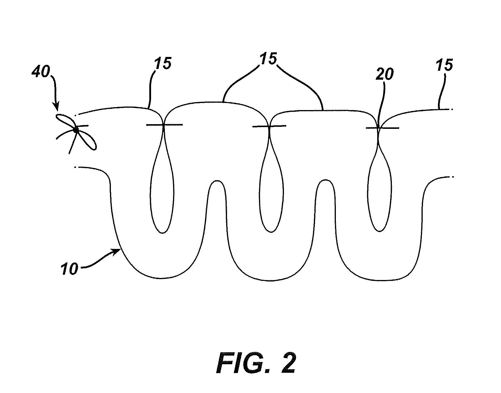 Methods and devices for the rerouting of chyme to induce intestinal brake