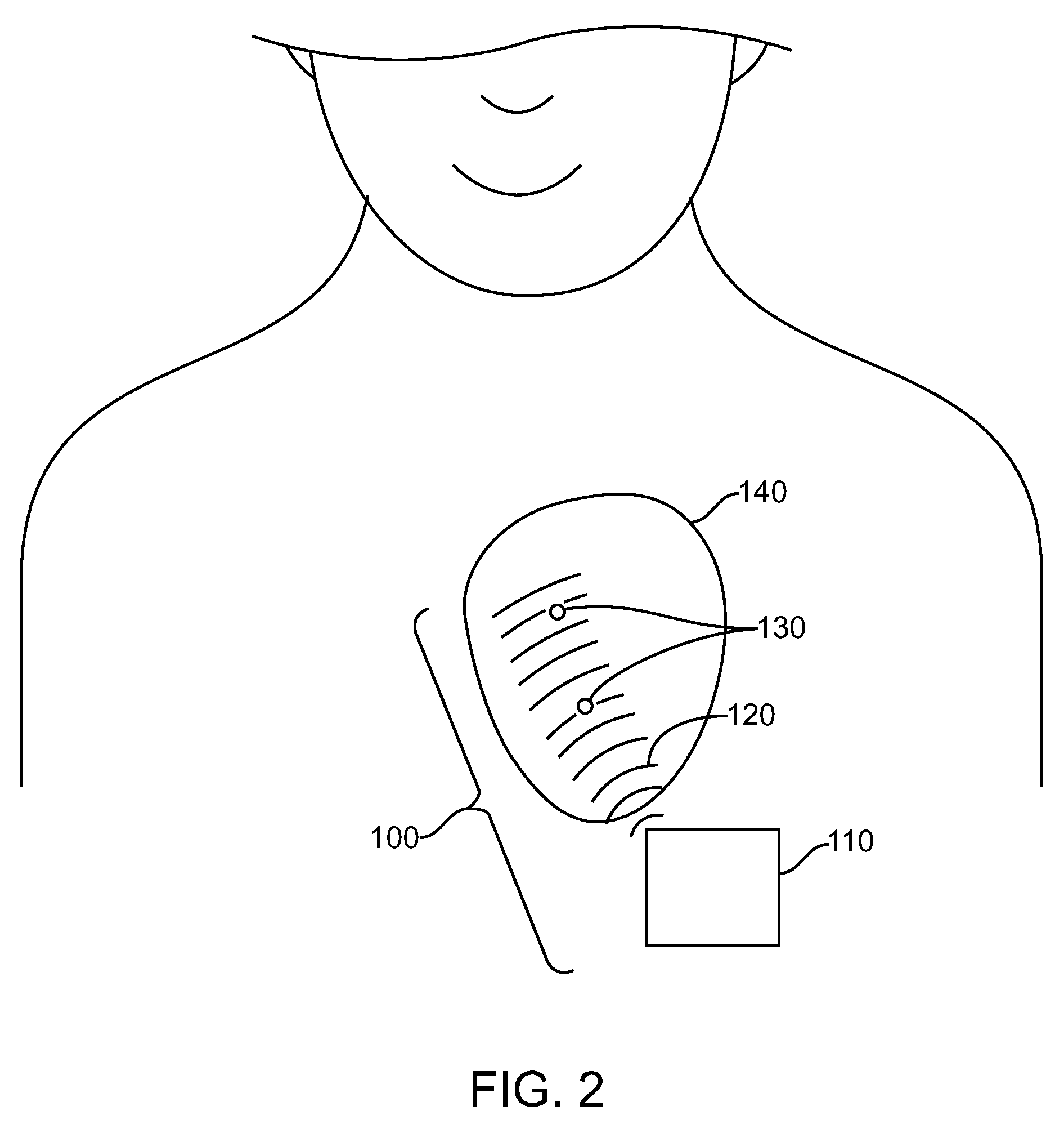 Operation and estimation of output voltage of wireless stimulators