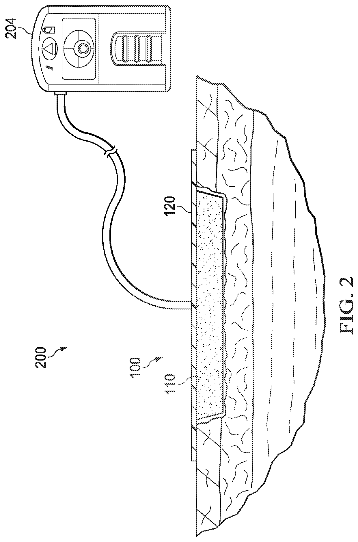 Post-operative surgical wound dressing