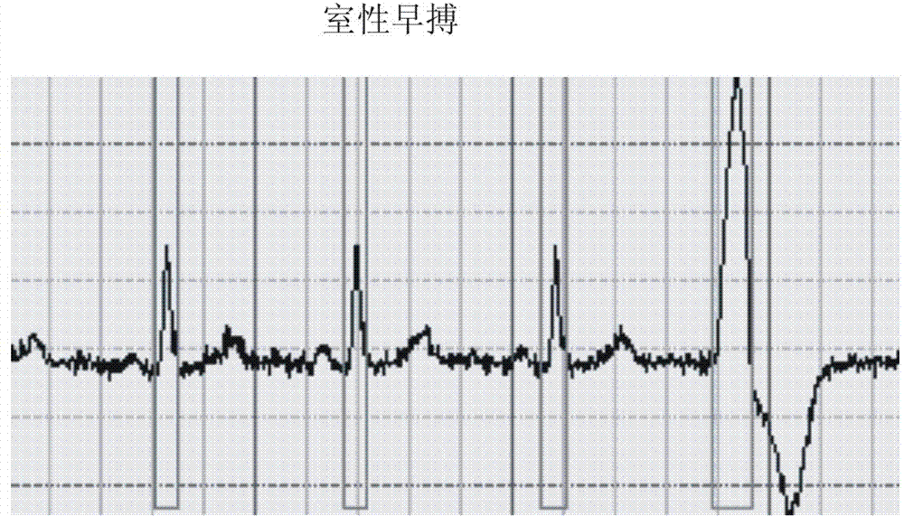 Automatic electrocardiogram recognition system