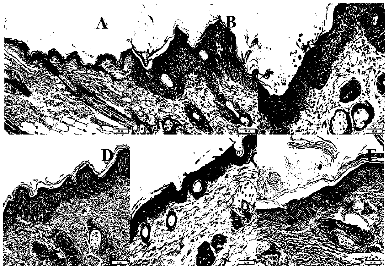 Application of a monoclonal antibody in the treatment of psoriasis