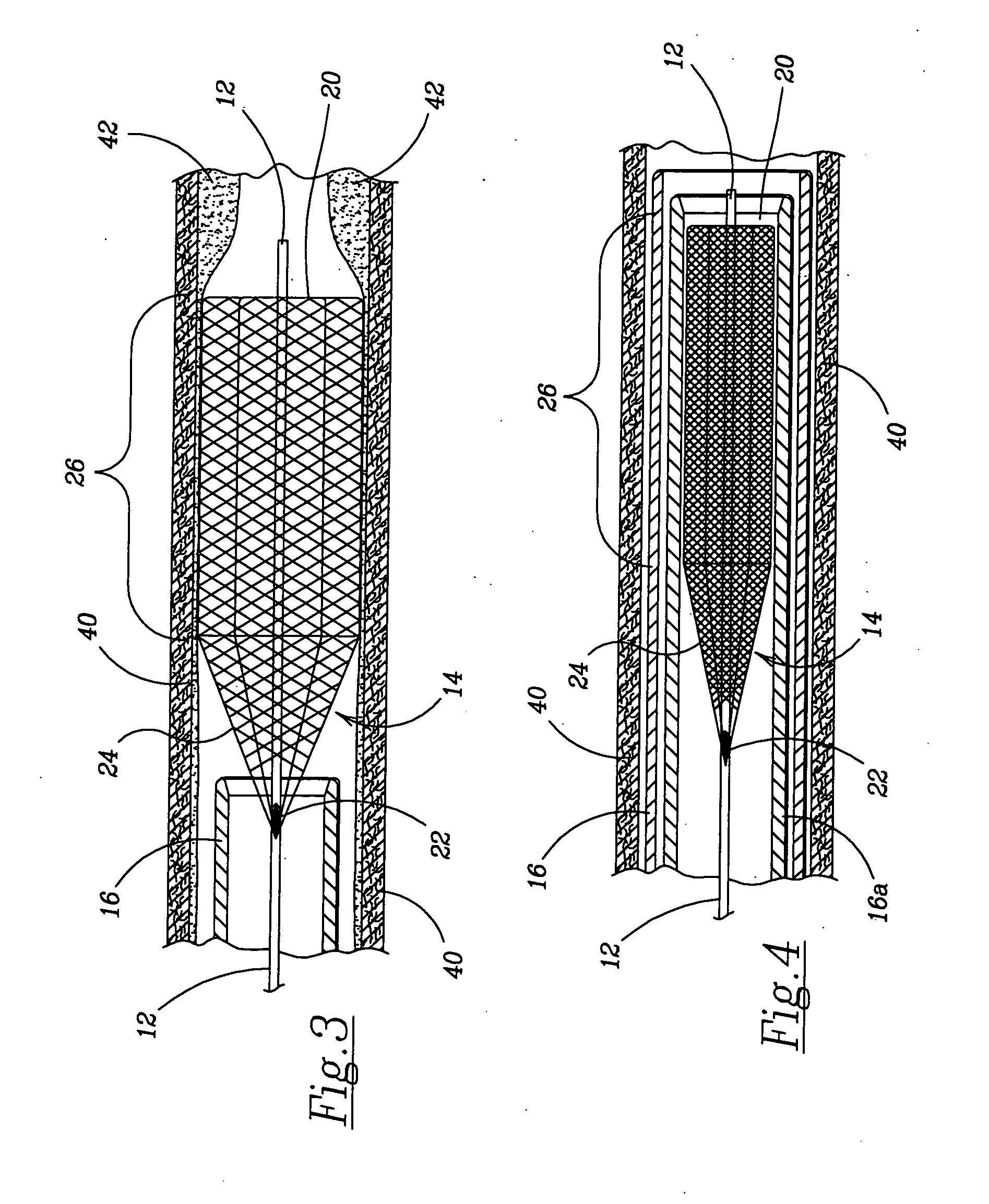 Retractable flow maintaining stent wire