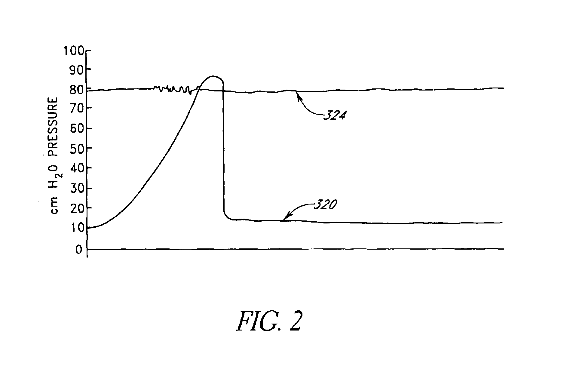 Implantable valved pressure attenuation device