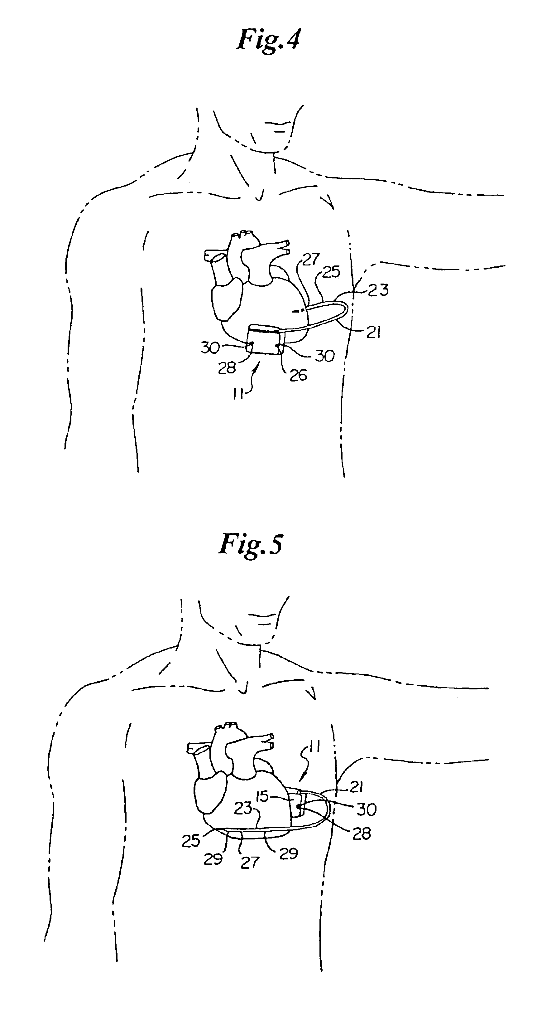 Canister designs for implantable cardioverter-defibrillators