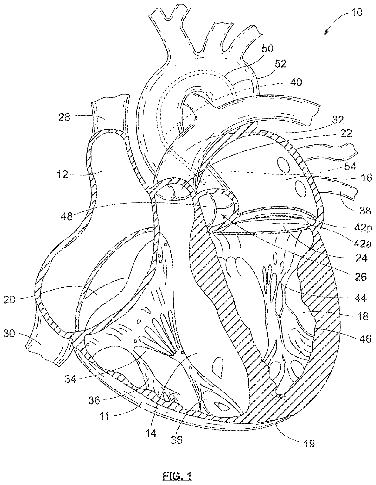 Bicuspid valve dissection device