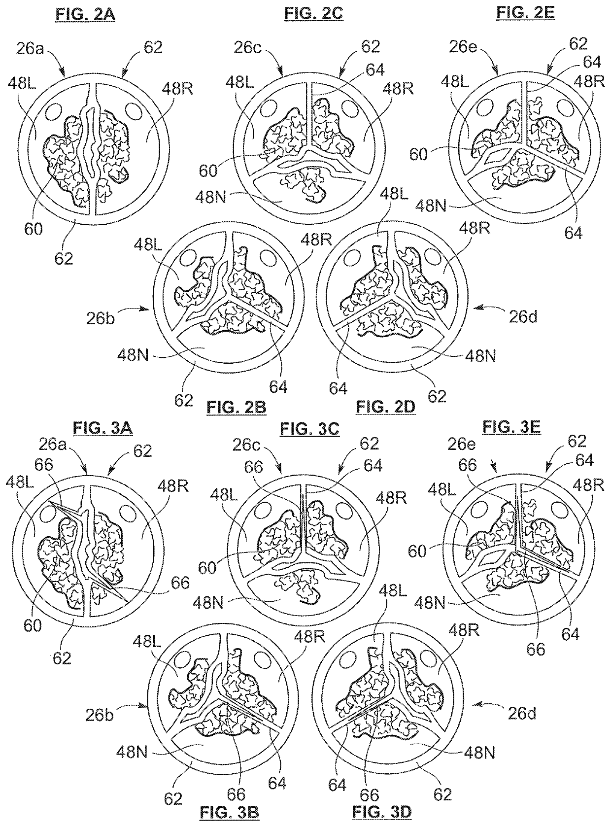 Bicuspid valve dissection device