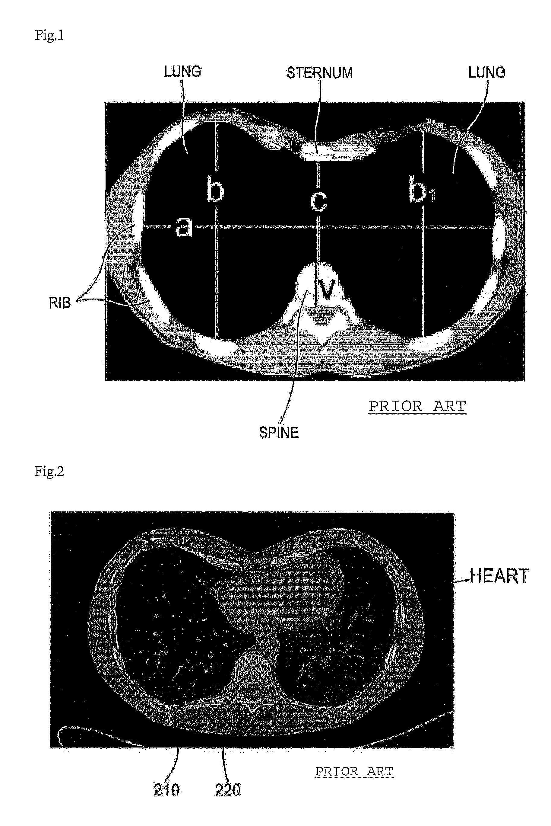 Automation method for computerized tomography image analysis using automated calculation of evaluation index of degree of thoracic deformation based on automatic initialization, and record medium and apparatus