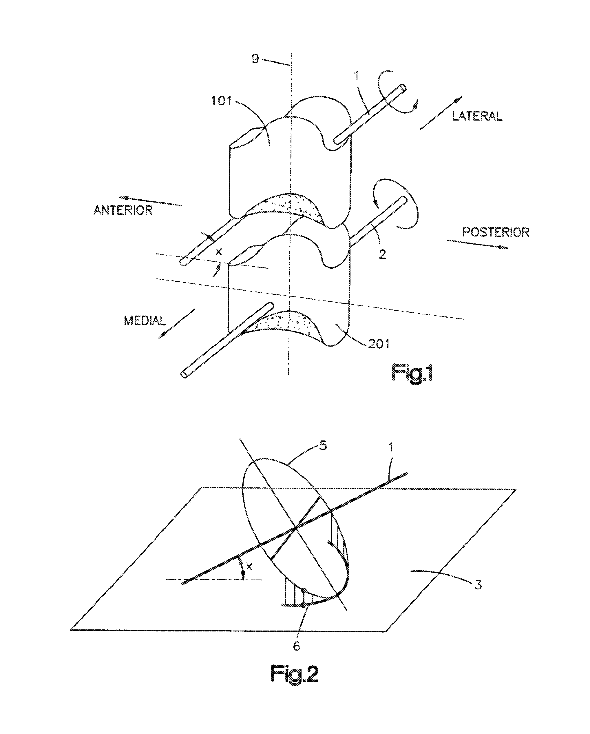 Articulating disc implant