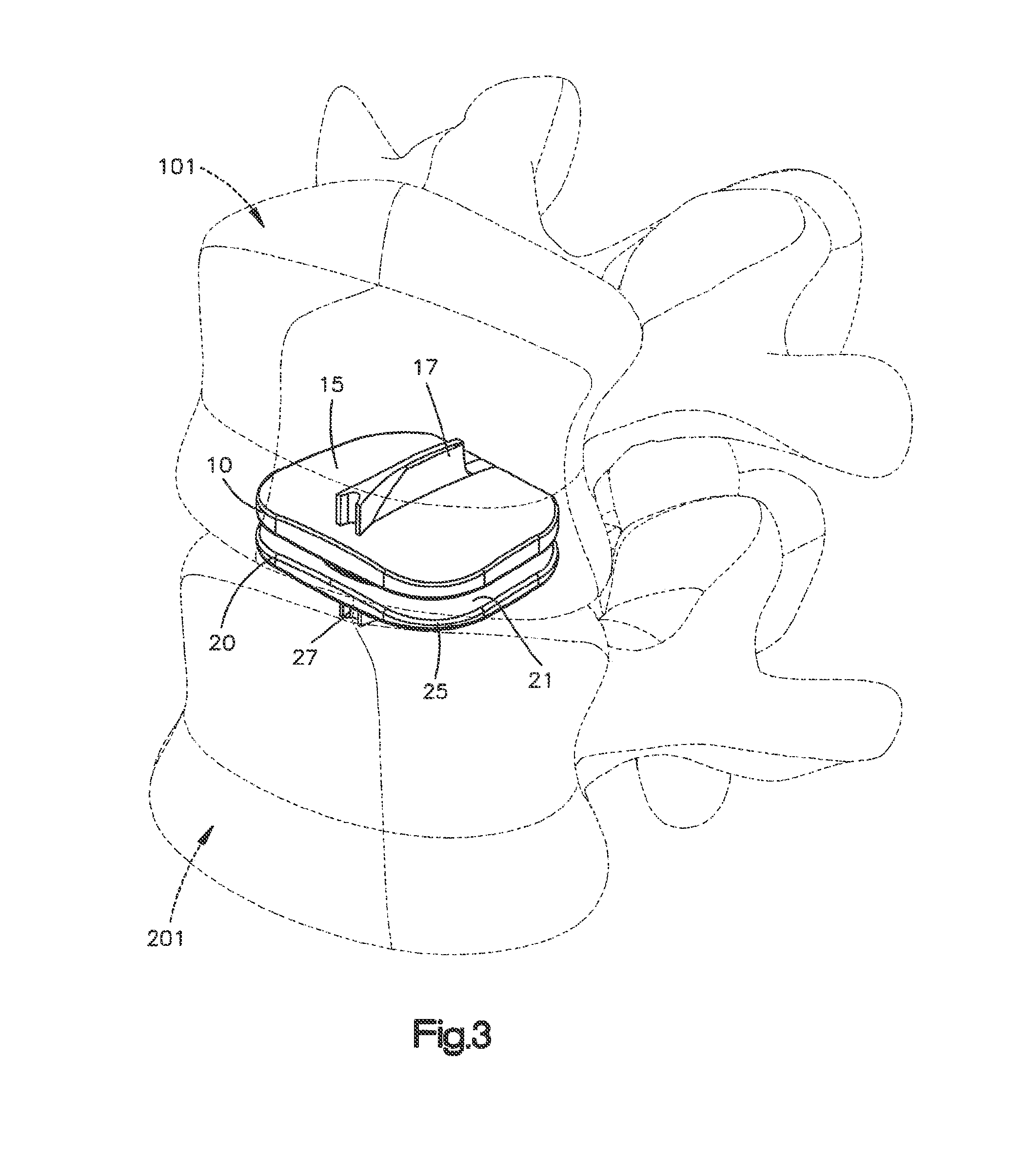 Articulating disc implant