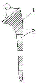 Artificial hip joint prosthesis handle for treating periprosthetic fracture