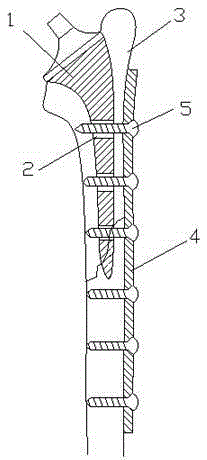 Artificial hip joint prosthesis handle for treating periprosthetic fracture