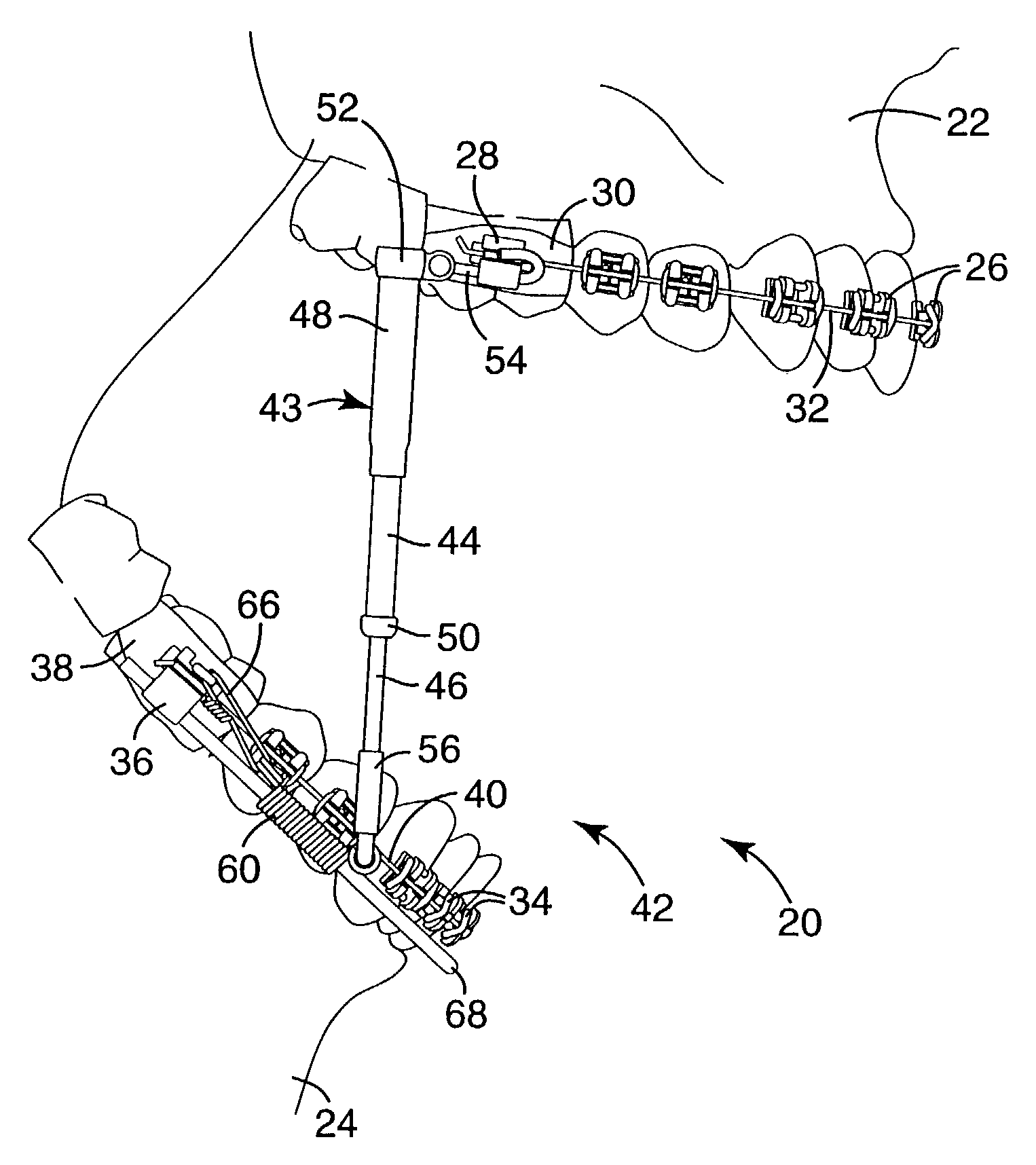 Mandibular repositioning assembly