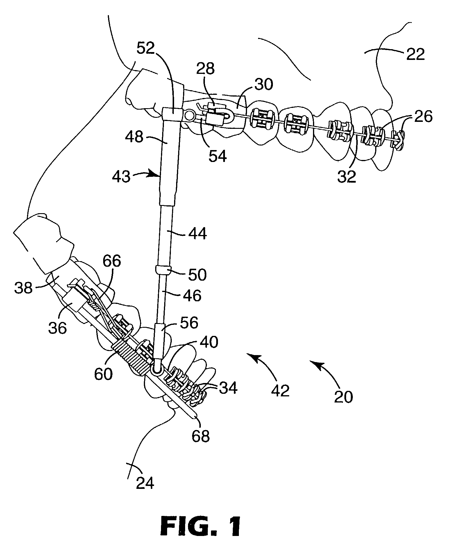 Mandibular repositioning assembly