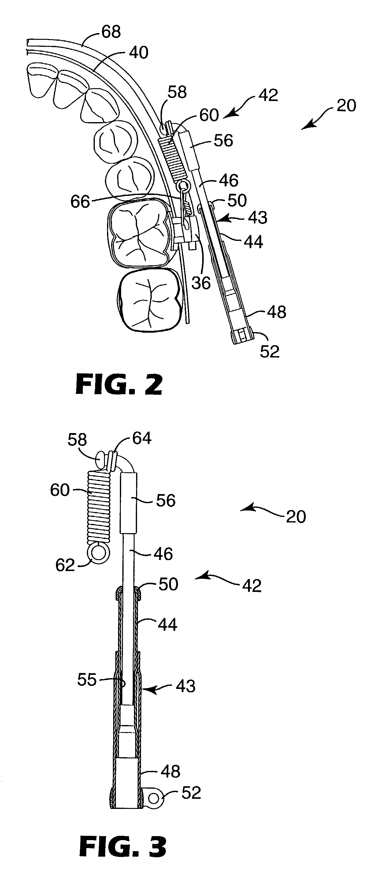 Mandibular repositioning assembly