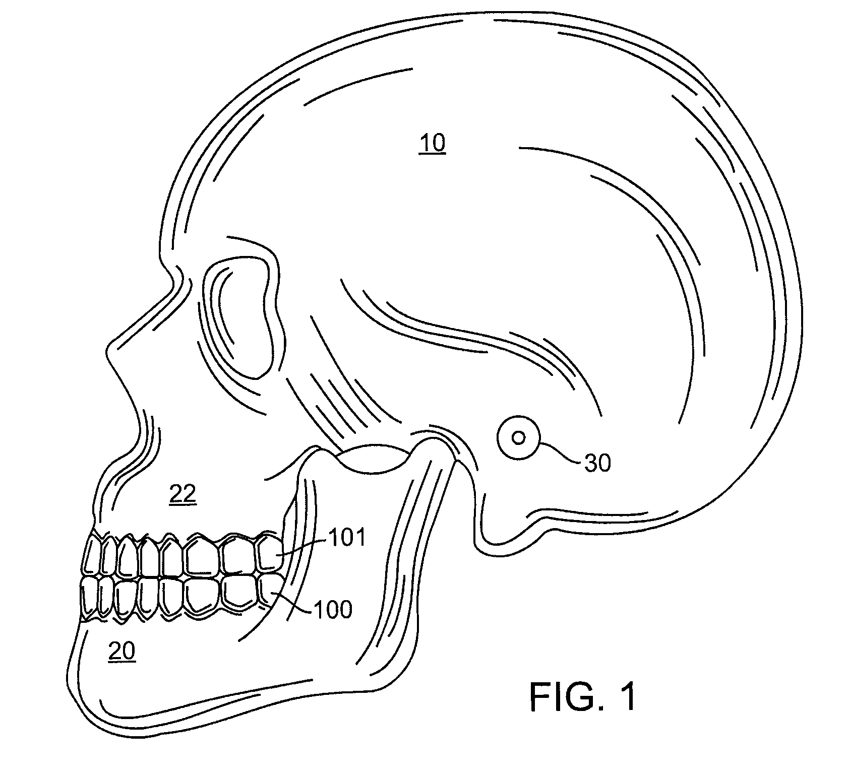 Tooth movement measurement by automatic impression matching