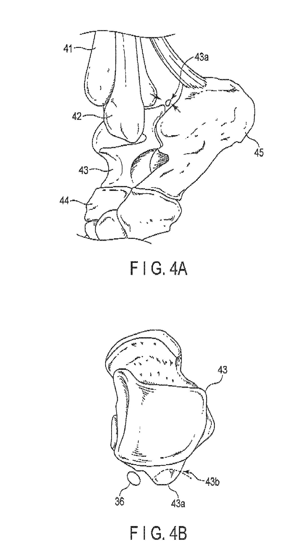 Arthroscopic surgery method for ankle impingement