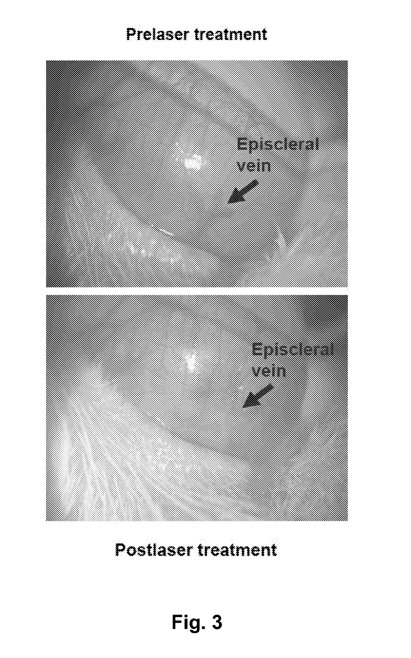 Methods for Treating Pressure Induced Optic Neuropathy, Preventing Neuronal Degeneration and Promoting Neuronal Cell Survival Via Administration of Lingo-1 Antagonists and TrkB Agonists