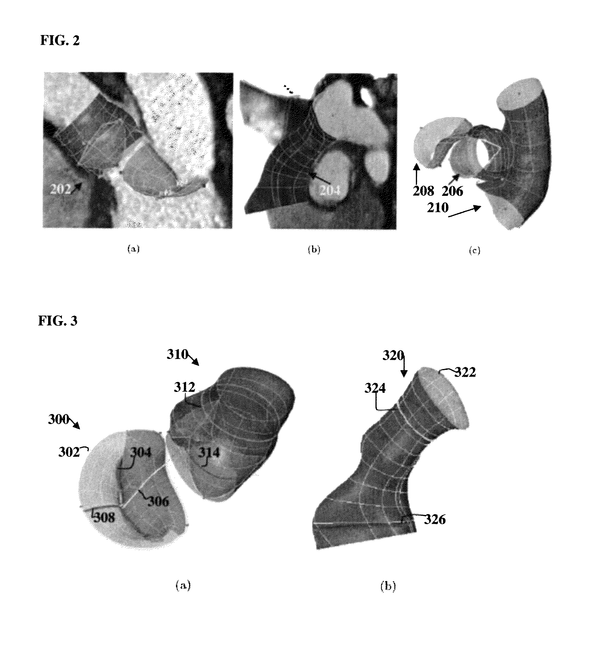 Method and system for medical decision support using organ models and learning based discriminative distance functions