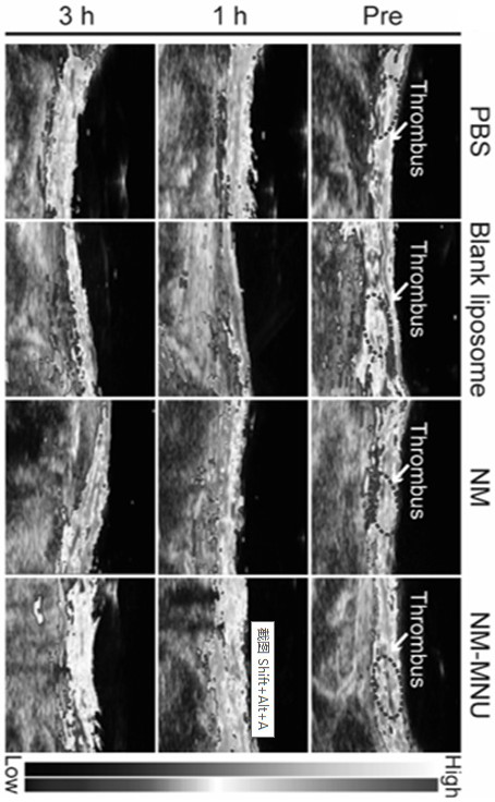 Ultrasonic and near-infrared light excited phase-change magnetic nano thrombolytic drug and preparation method thereof