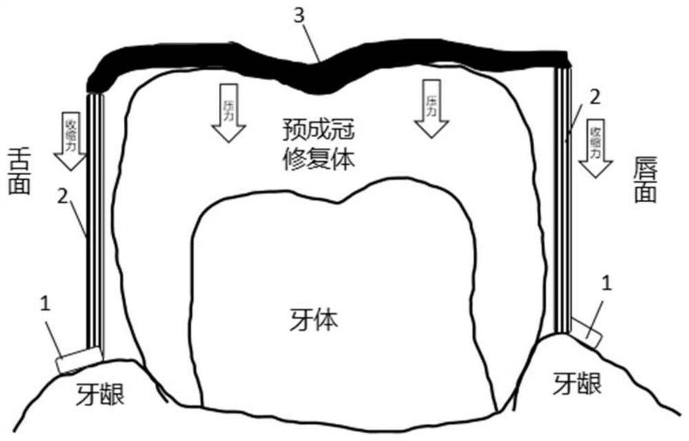 Self-shrinking preformed crown retention joint strip