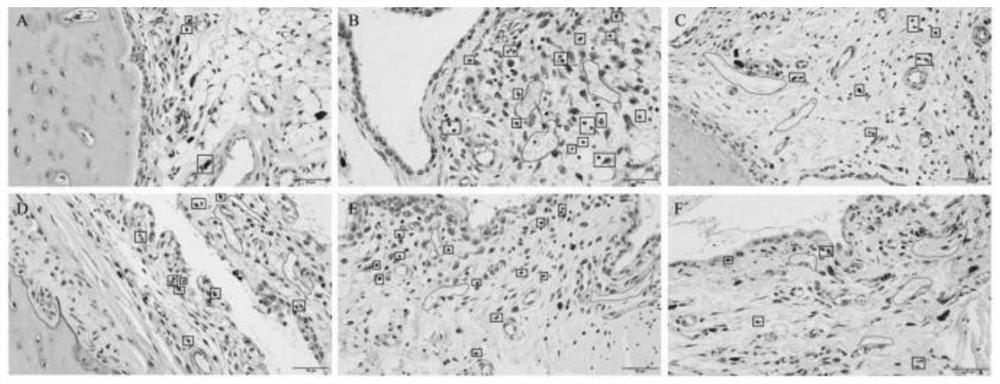 Zhuang medicine composition with treatment effect on acute gouty arthritis, Zhuang medicine granules and preparation method of Zhuang medicine composition and Zhuang medicine granules