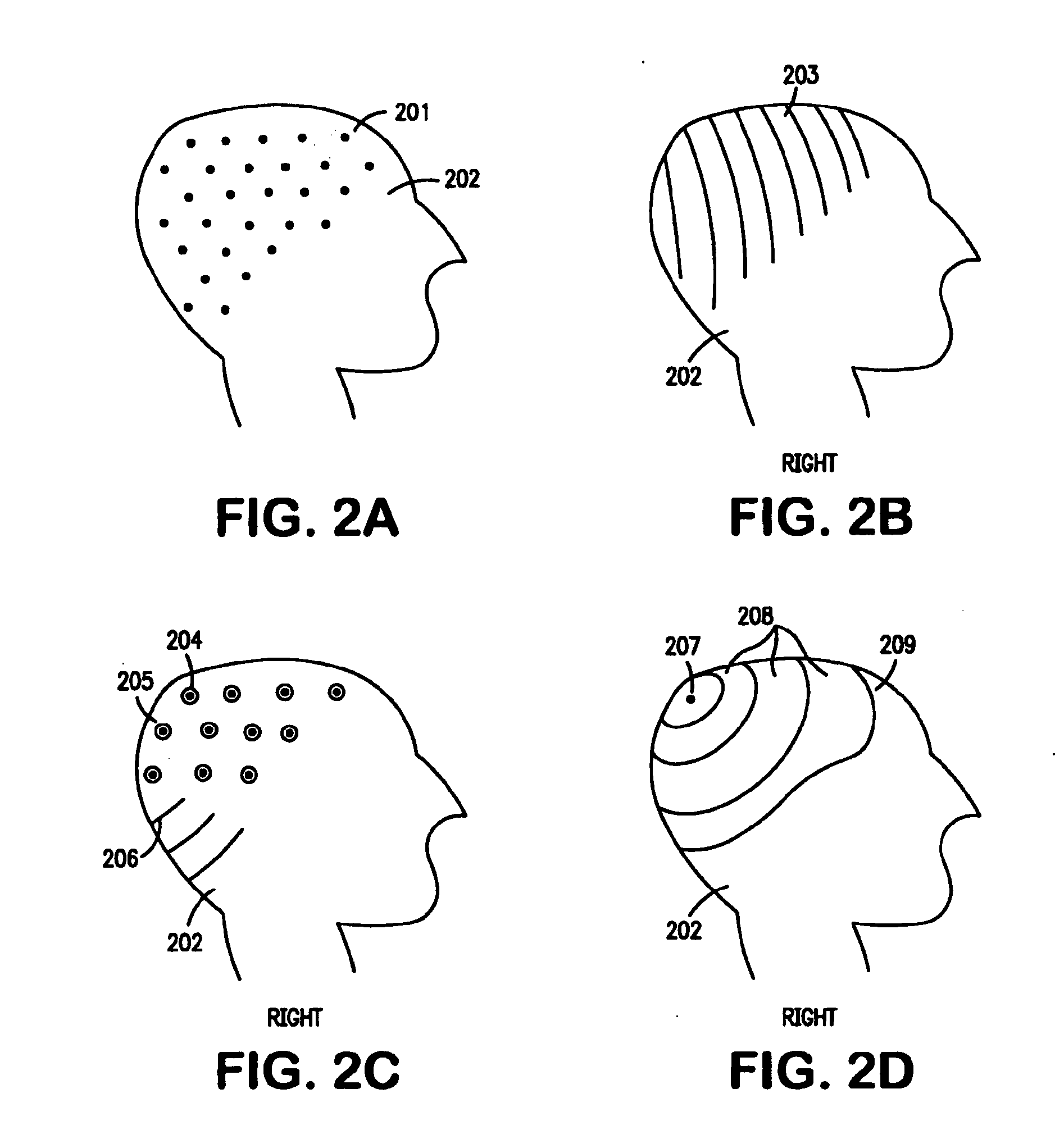 Treatment of neurological disorders via electrical stimulation, and methods related thereto