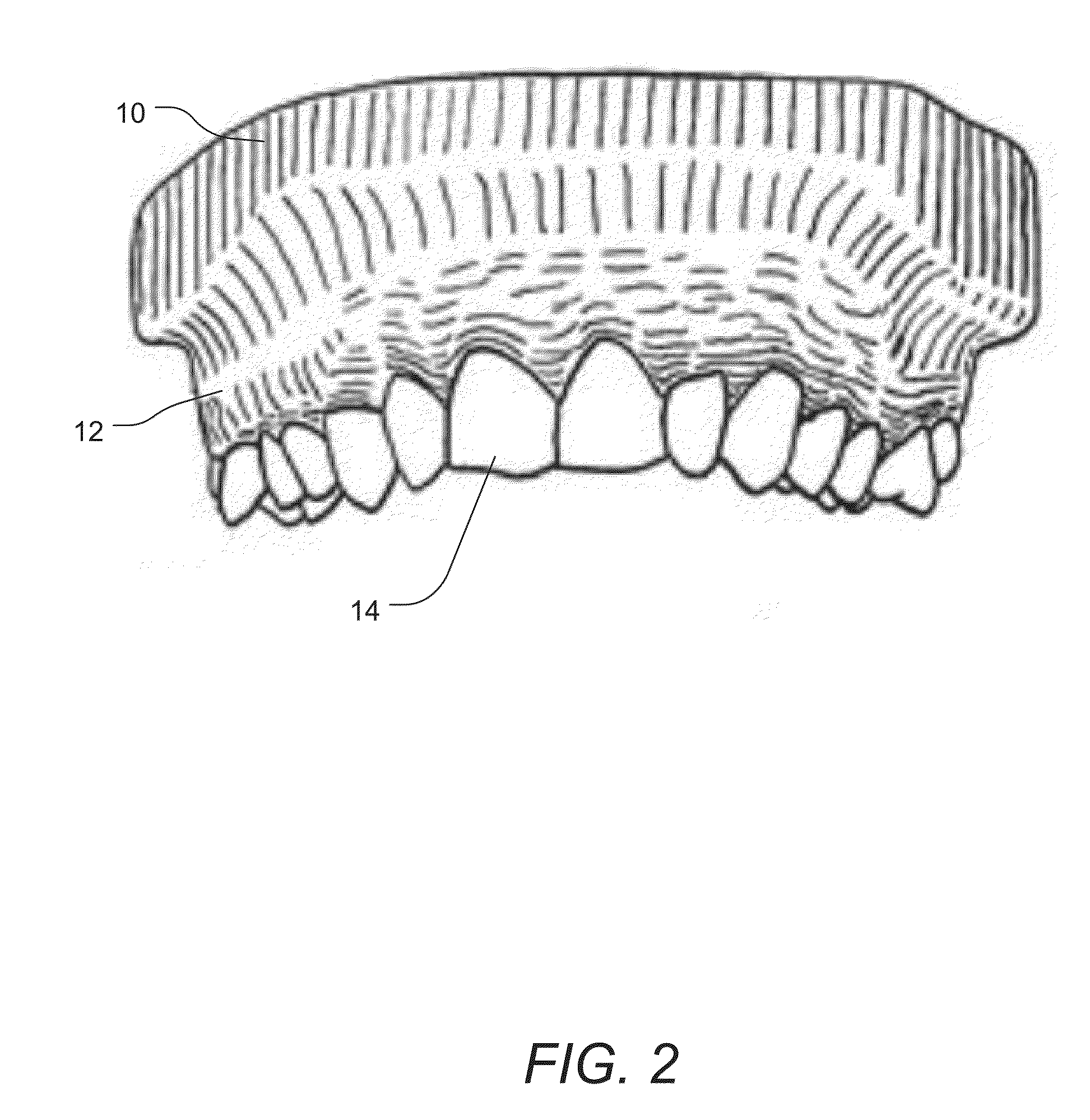 Non-surgical systems and methods for treating receding gums