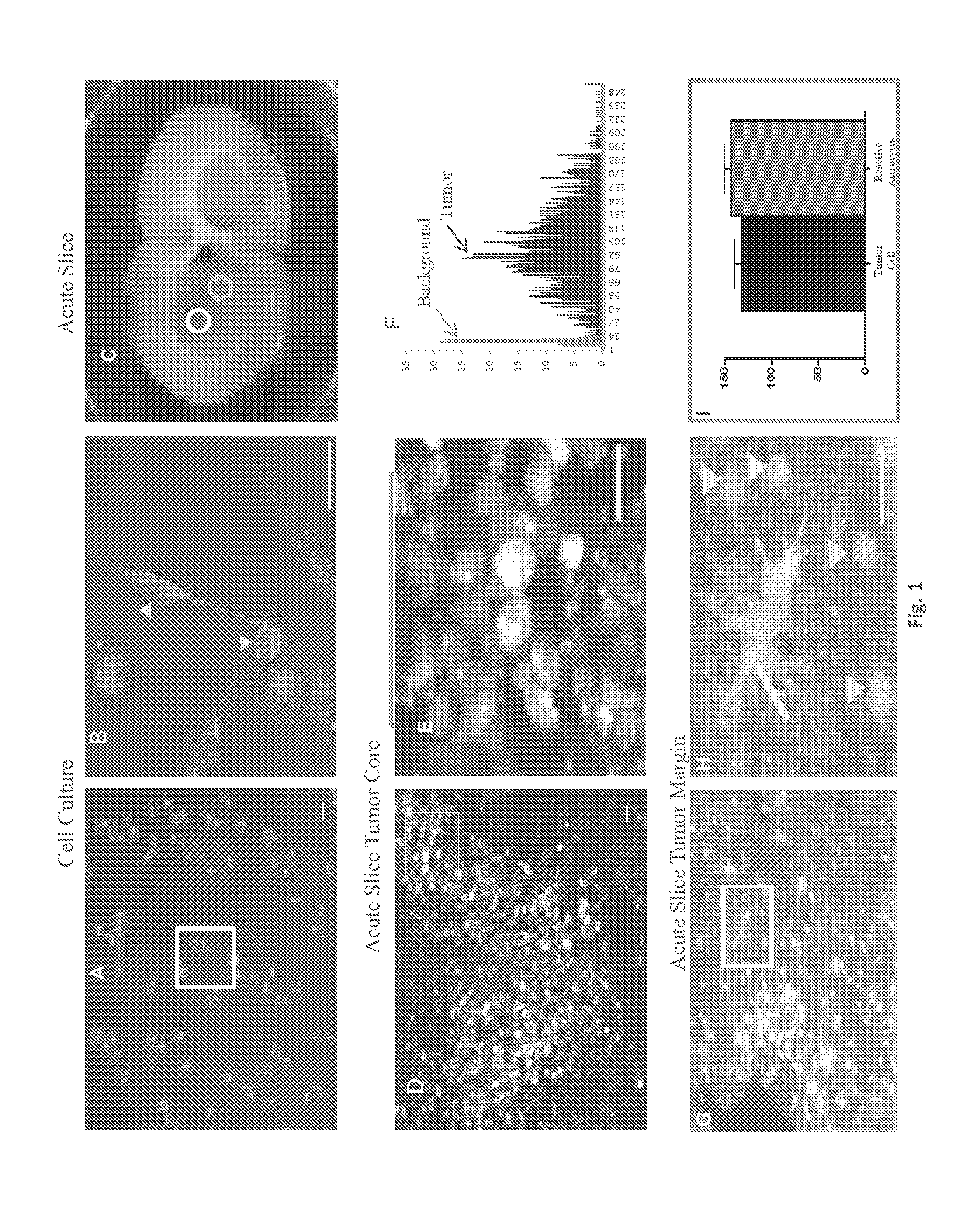 System and Method for Diagnosis of Astrocytic Brain Tumor