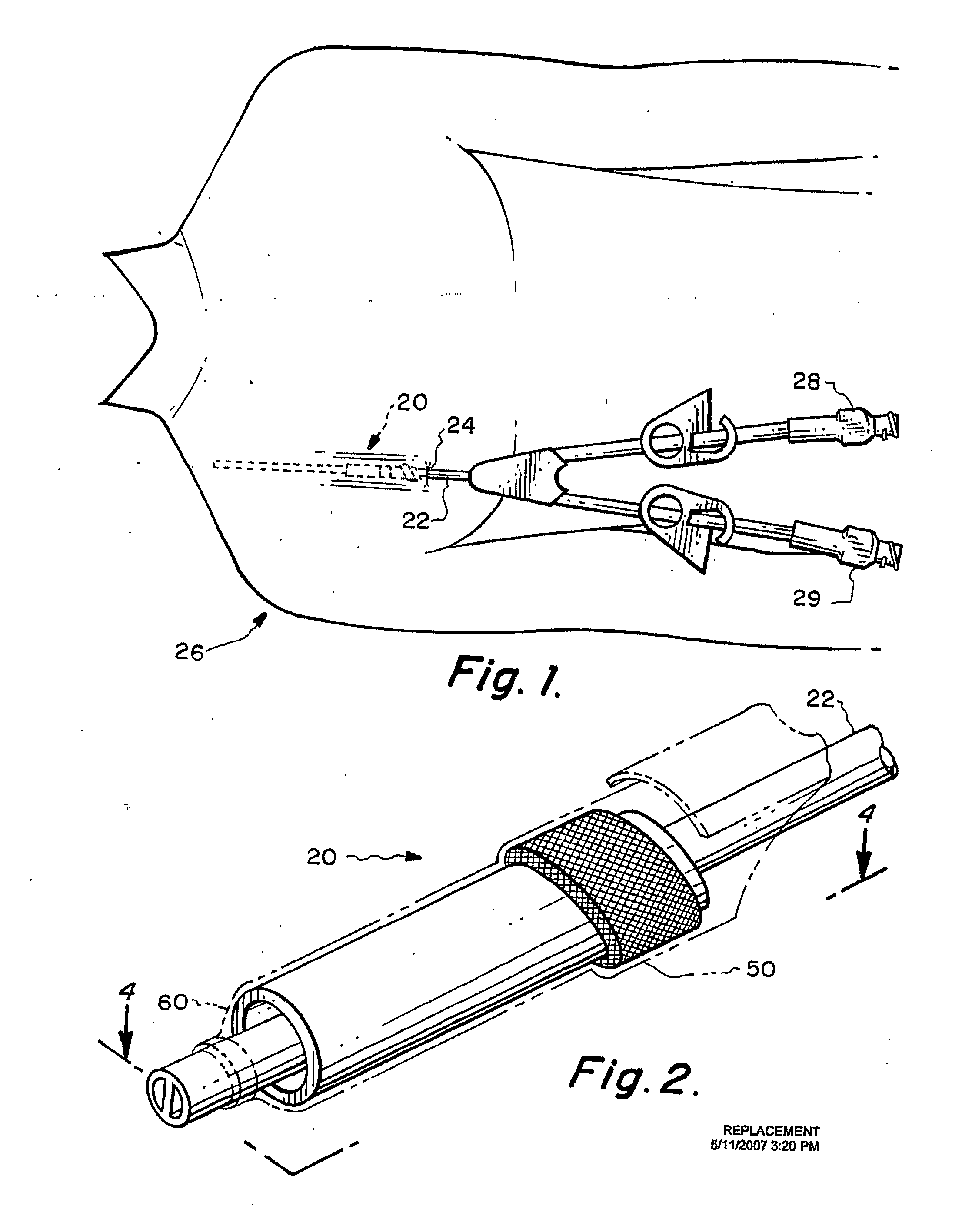 Method and Subcutaneous Apparatus for Facilitating the Replacement of an Implanted Catheter